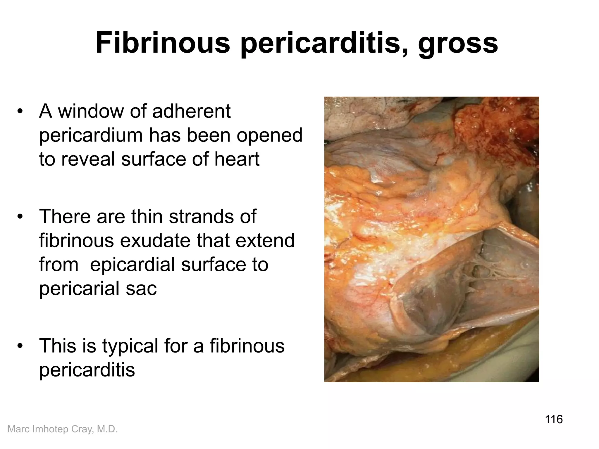 Marc Imhotep Cray, M.D.
Fibrinous pericarditis, gross
• A window of adherent
pericardium has been opened
to reveal surface of heart
• There are thin strands of
fibrinous exudate that extend
from epicardial surface to
pericarial sac
• This is typical for a fibrinous
pericarditis
116
 