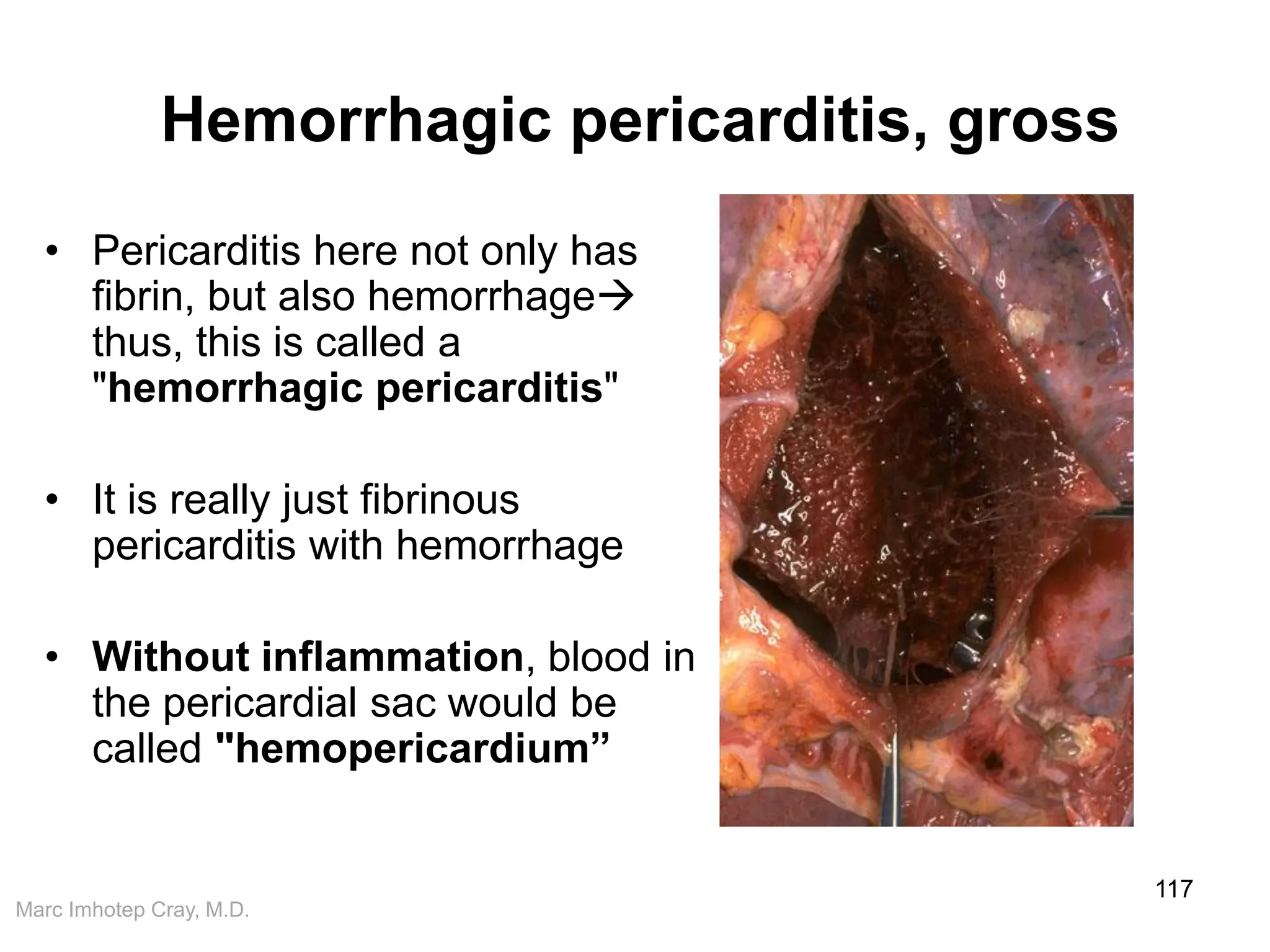 Marc Imhotep Cray, M.D.
Hemorrhagic pericarditis, gross
• Pericarditis here not only has
fibrin, but also hemorrhage
thus, this is called a
"hemorrhagic pericarditis"
• It is really just fibrinous
pericarditis with hemorrhage
• Without inflammation, blood in
the pericardial sac would be
called "hemopericardium”
117
 