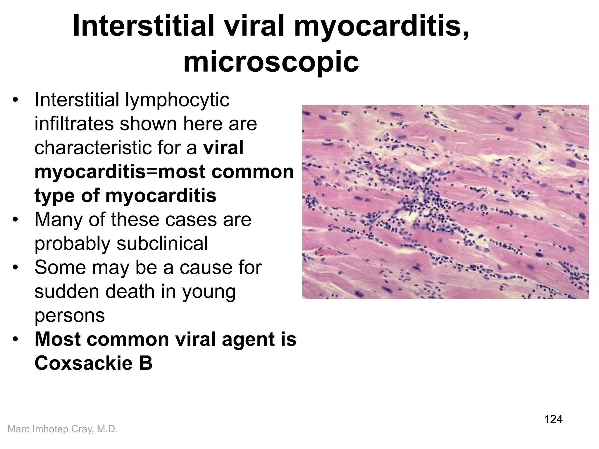 Marc Imhotep Cray, M.D.
Interstitial viral myocarditis,
microscopic
124
• Interstitial lymphocytic
infiltrates shown here are
characteristic for a viral
myocarditis=most common
type of myocarditis
• Many of these cases are
probably subclinical
• Some may be a cause for
sudden death in young
persons
• Most common viral agent is
Coxsackie B
 