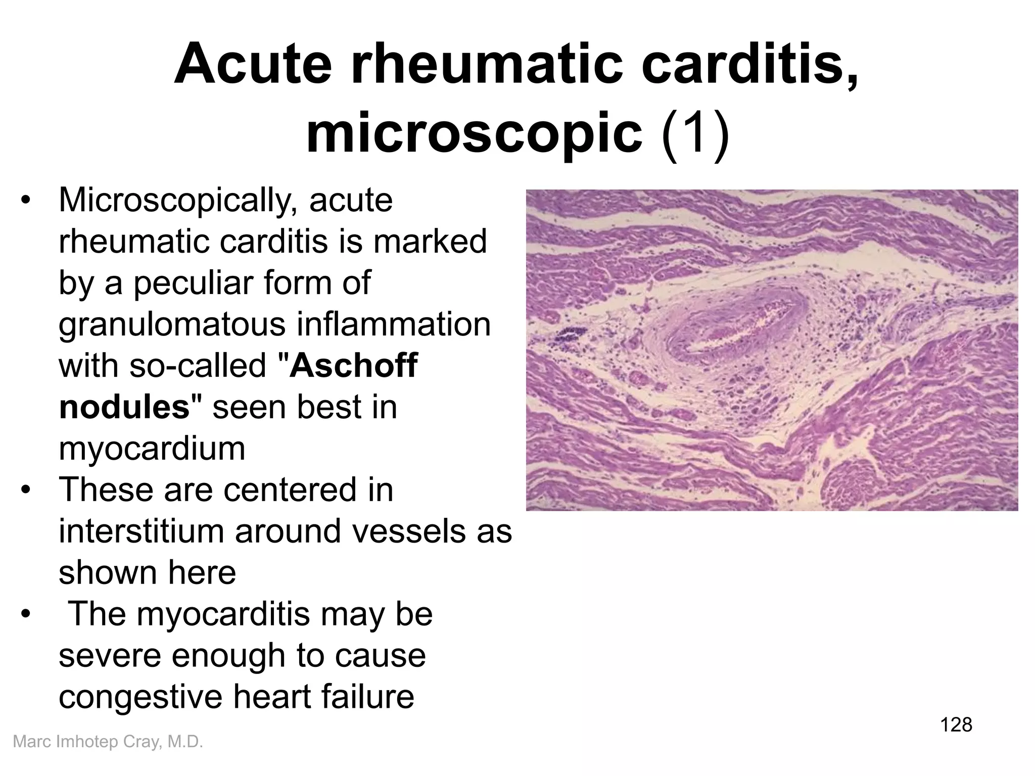 Marc Imhotep Cray, M.D.
Acute rheumatic carditis,
microscopic (1)
128
• Microscopically, acute
rheumatic carditis is marked
by a peculiar form of
granulomatous inflammation
with so-called "Aschoff
nodules" seen best in
myocardium
• These are centered in
interstitium around vessels as
shown here
• The myocarditis may be
severe enough to cause
congestive heart failure
 