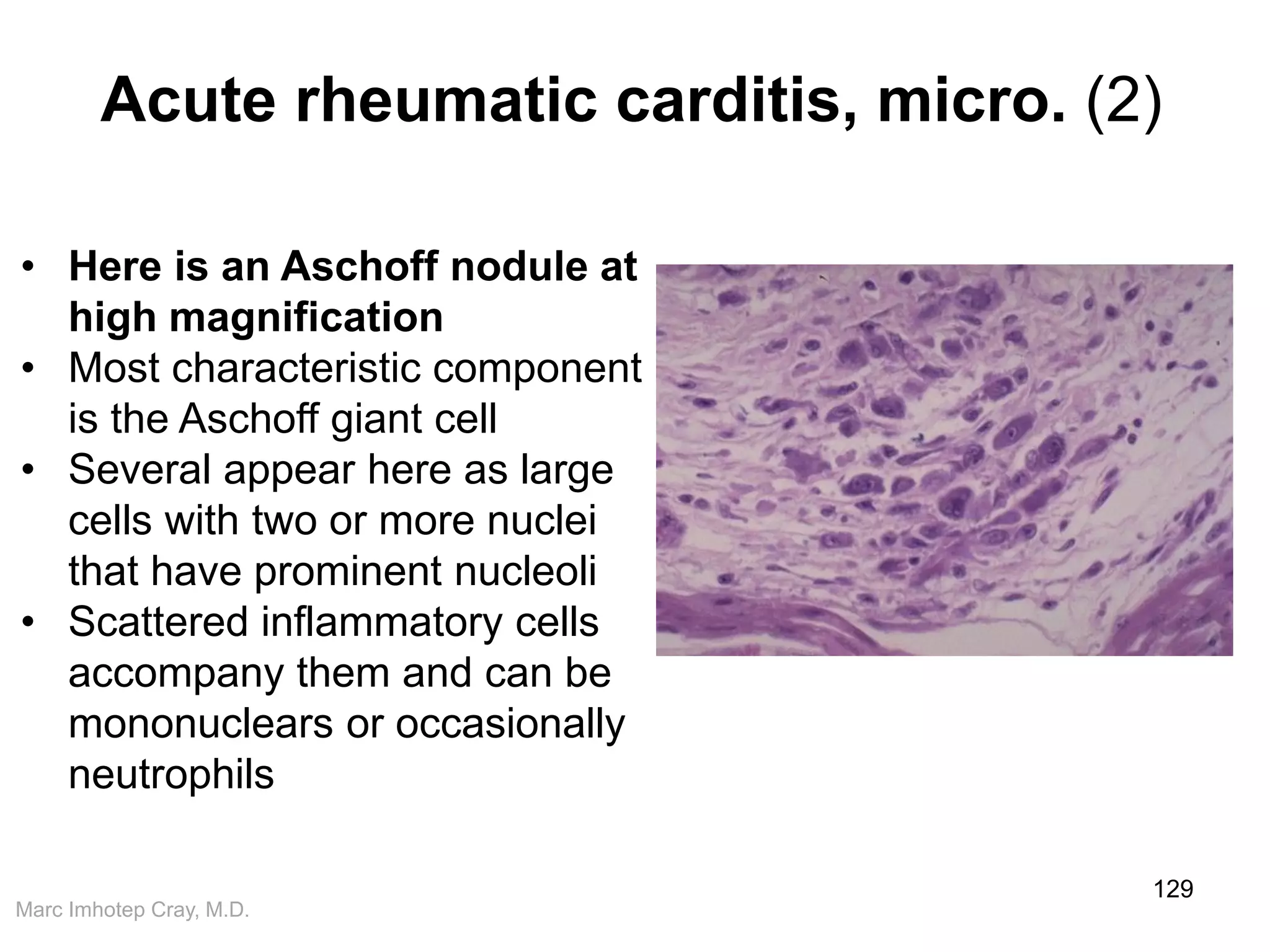 Marc Imhotep Cray, M.D.
Acute rheumatic carditis, micro. (2)
129
• Here is an Aschoff nodule at
high magnification
• Most characteristic component
is the Aschoff giant cell
• Several appear here as large
cells with two or more nuclei
that have prominent nucleoli
• Scattered inflammatory cells
accompany them and can be
mononuclears or occasionally
neutrophils
 
