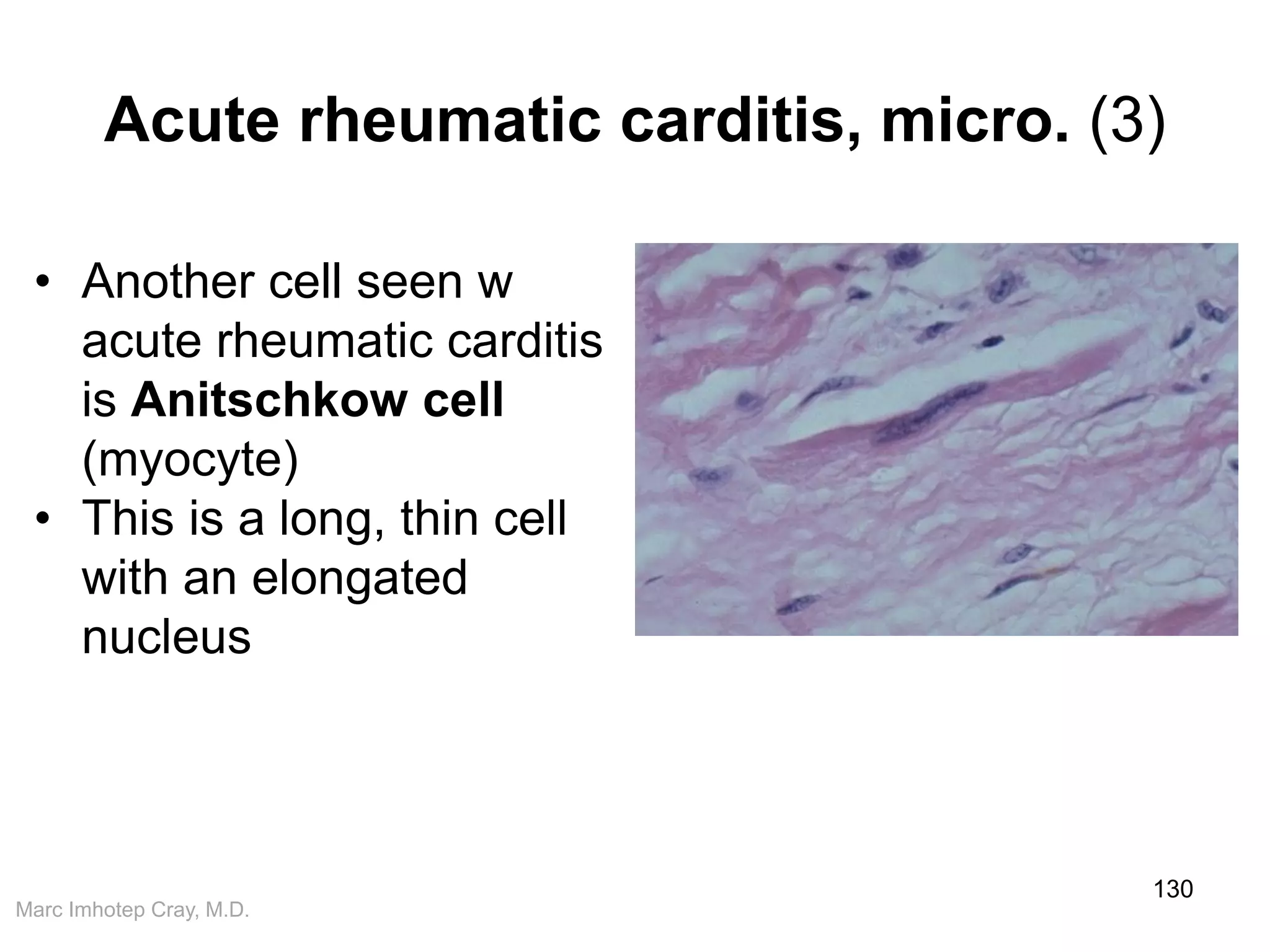 Marc Imhotep Cray, M.D.
Acute rheumatic carditis, micro. (3)
130
• Another cell seen w
acute rheumatic carditis
is Anitschkow cell
(myocyte)
• This is a long, thin cell
with an elongated
nucleus
 