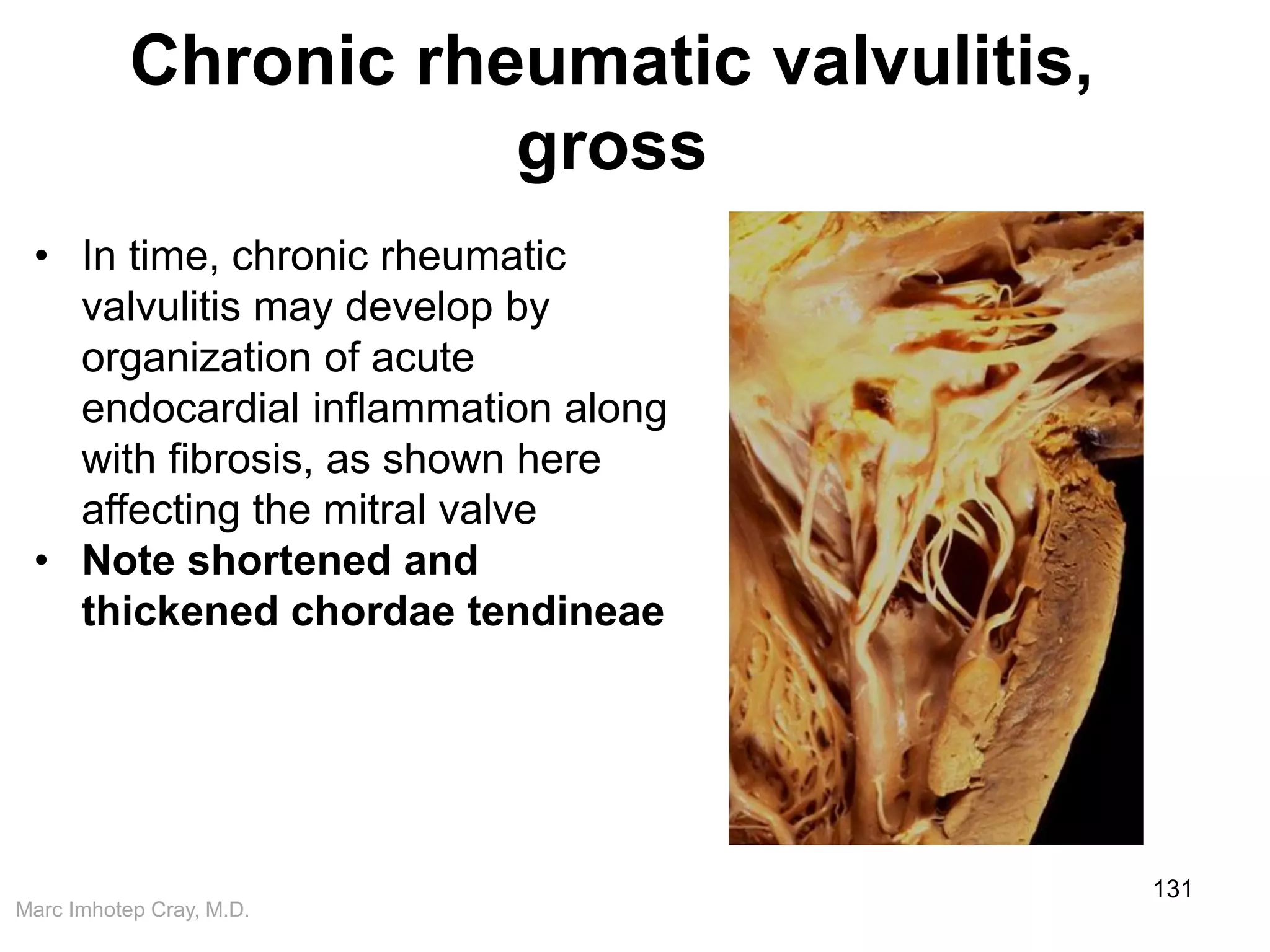 Marc Imhotep Cray, M.D.
Chronic rheumatic valvulitis,
gross
131
• In time, chronic rheumatic
valvulitis may develop by
organization of acute
endocardial inflammation along
with fibrosis, as shown here
affecting the mitral valve
• Note shortened and
thickened chordae tendineae
 