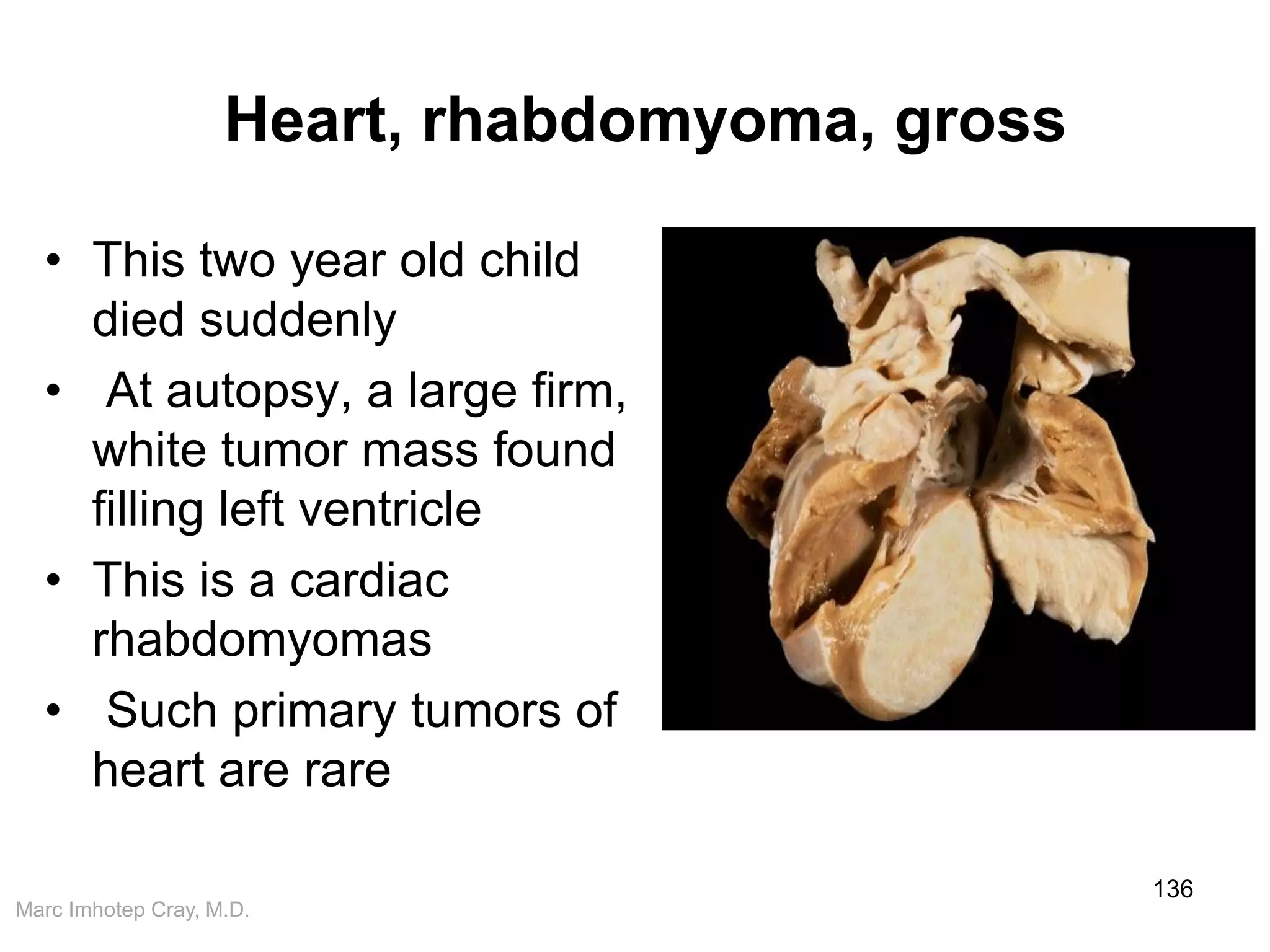 Marc Imhotep Cray, M.D.
Heart, rhabdomyoma, gross
• This two year old child
died suddenly
• At autopsy, a large firm,
white tumor mass found
filling left ventricle
• This is a cardiac
rhabdomyomas
• Such primary tumors of
heart are rare
136
 