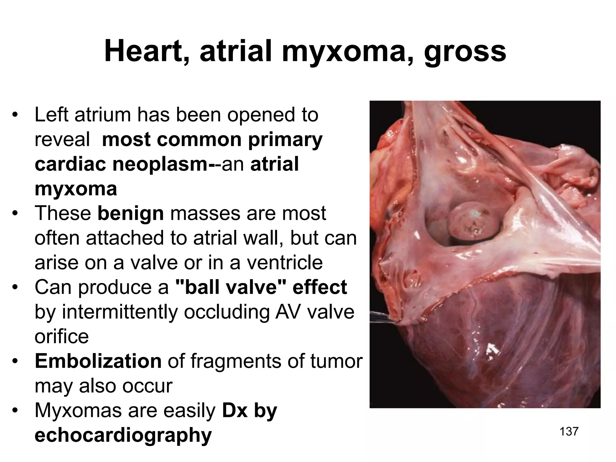 Marc Imhotep Cray, M.D.
Heart, atrial myxoma, gross
137
• Left atrium has been opened to
reveal most common primary
cardiac neoplasm--an atrial
myxoma
• These benign masses are most
often attached to atrial wall, but can
arise on a valve or in a ventricle
• Can produce a "ball valve" effect
by intermittently occluding AV valve
orifice
• Embolization of fragments of tumor
may also occur
• Myxomas are easily Dx by
echocardiography
 
