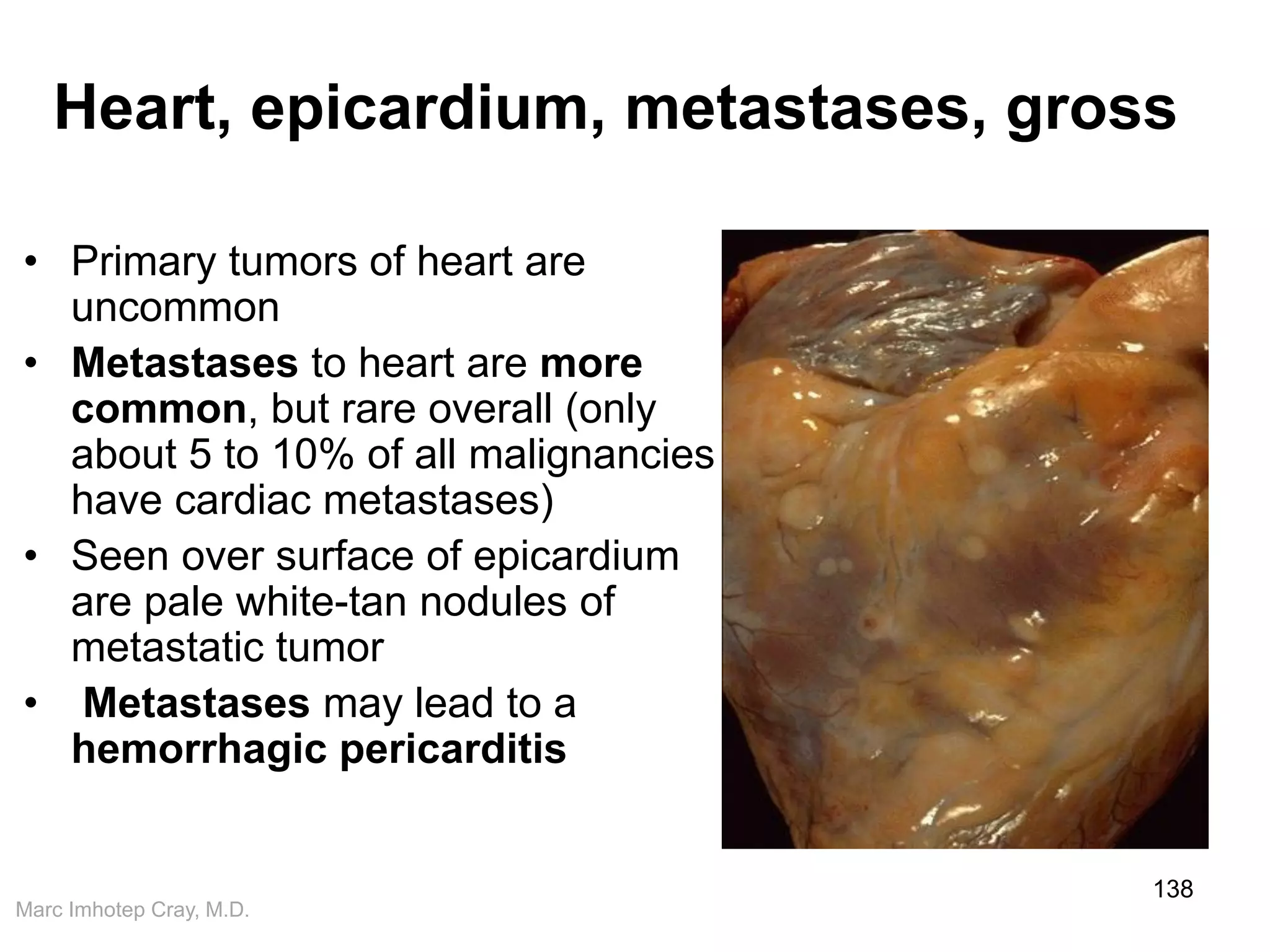 Marc Imhotep Cray, M.D.
Heart, epicardium, metastases, gross
• Primary tumors of heart are
uncommon
• Metastases to heart are more
common, but rare overall (only
about 5 to 10% of all malignancies
have cardiac metastases)
• Seen over surface of epicardium
are pale white-tan nodules of
metastatic tumor
• Metastases may lead to a
hemorrhagic pericarditis
138
 