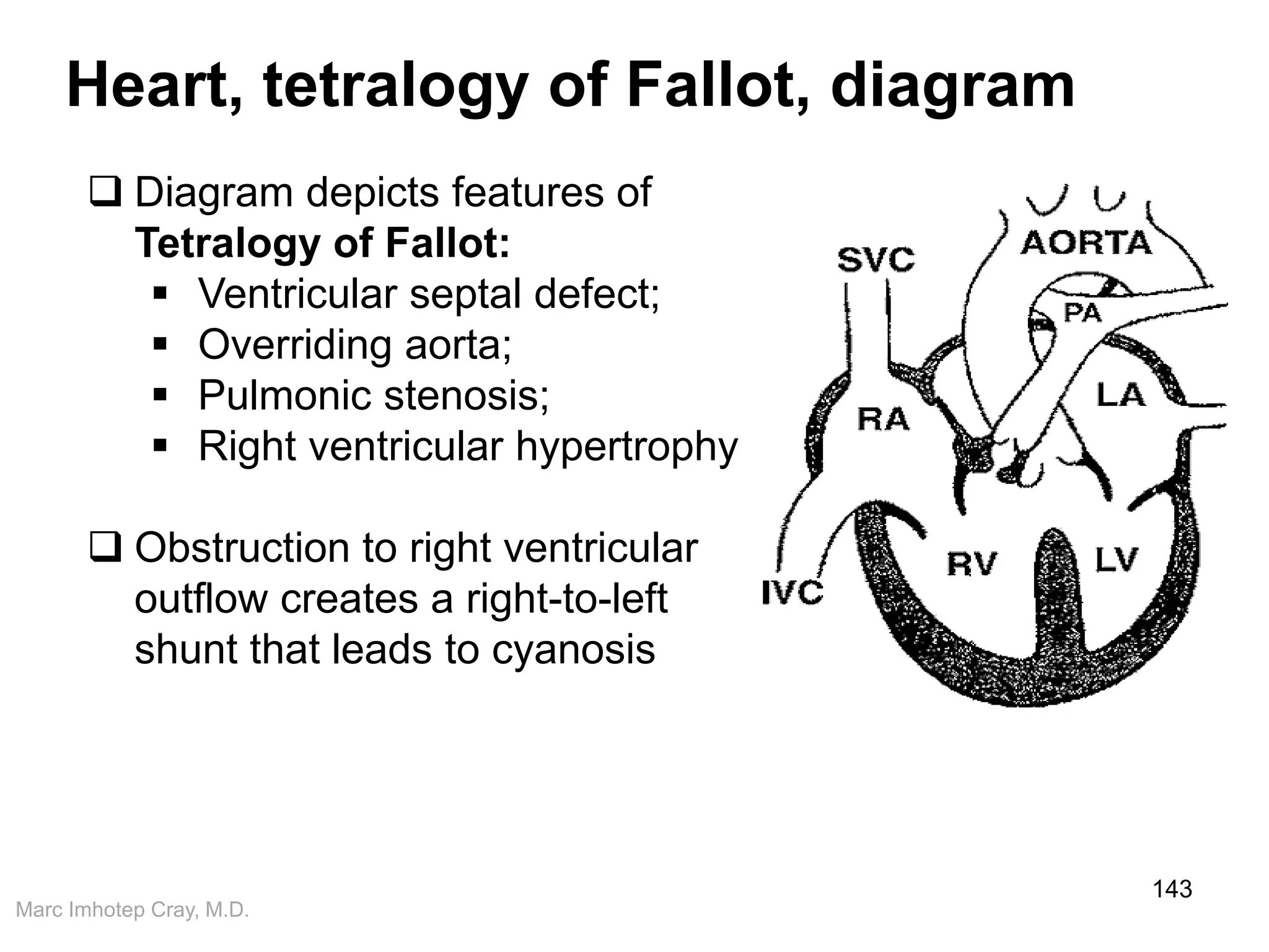 Marc Imhotep Cray, M.D.
Heart, tetralogy of Fallot, diagram
143
 Diagram depicts features of
Tetralogy of Fallot:
 Ventricular septal defect;
 Overriding aorta;
 Pulmonic stenosis;
 Right ventricular hypertrophy
 Obstruction to right ventricular
outflow creates a right-to-left
shunt that leads to cyanosis
 