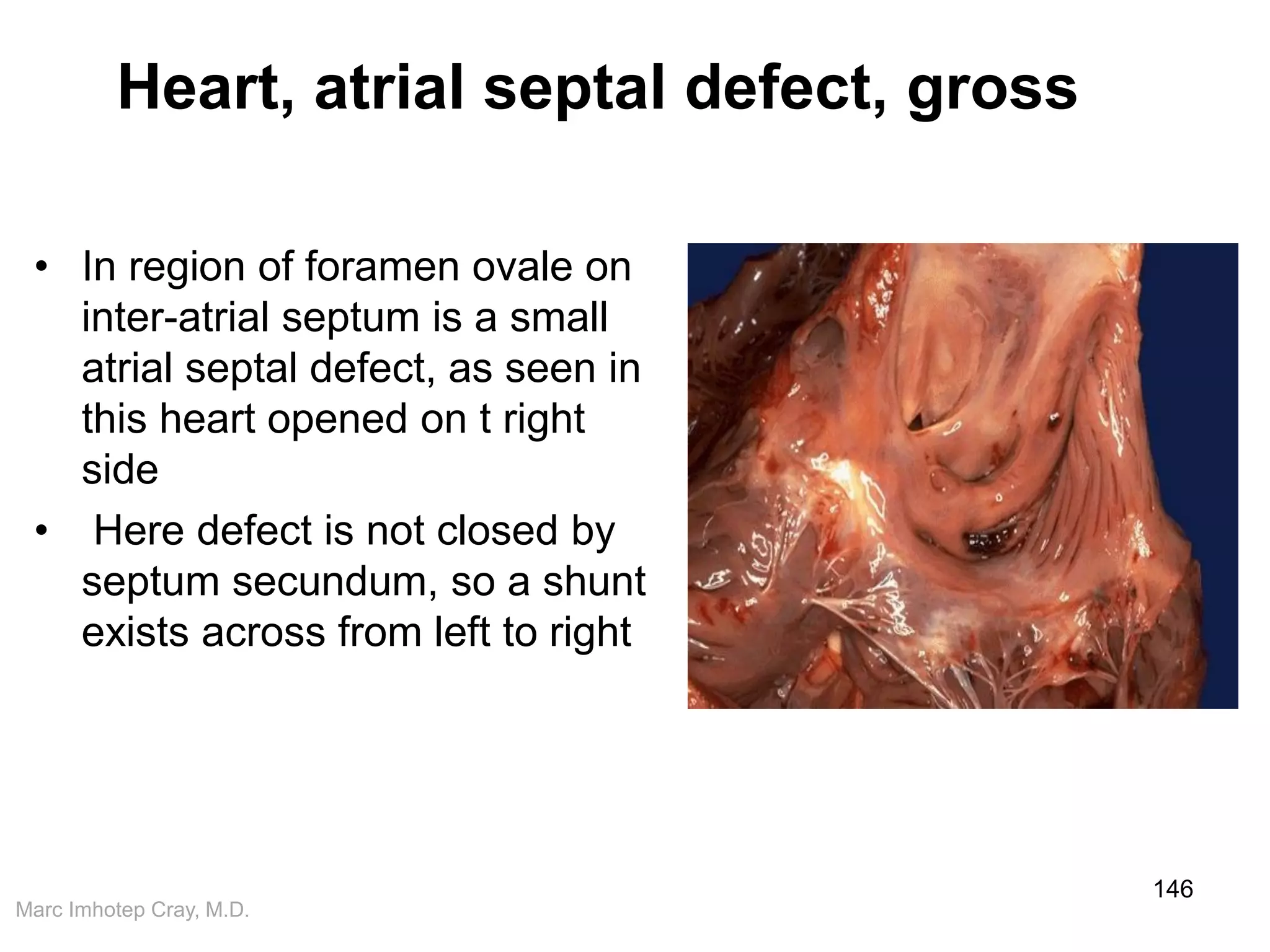 Marc Imhotep Cray, M.D.
Heart, atrial septal defect, gross
• In region of foramen ovale on
inter-atrial septum is a small
atrial septal defect, as seen in
this heart opened on t right
side
• Here defect is not closed by
septum secundum, so a shunt
exists across from left to right
146
 