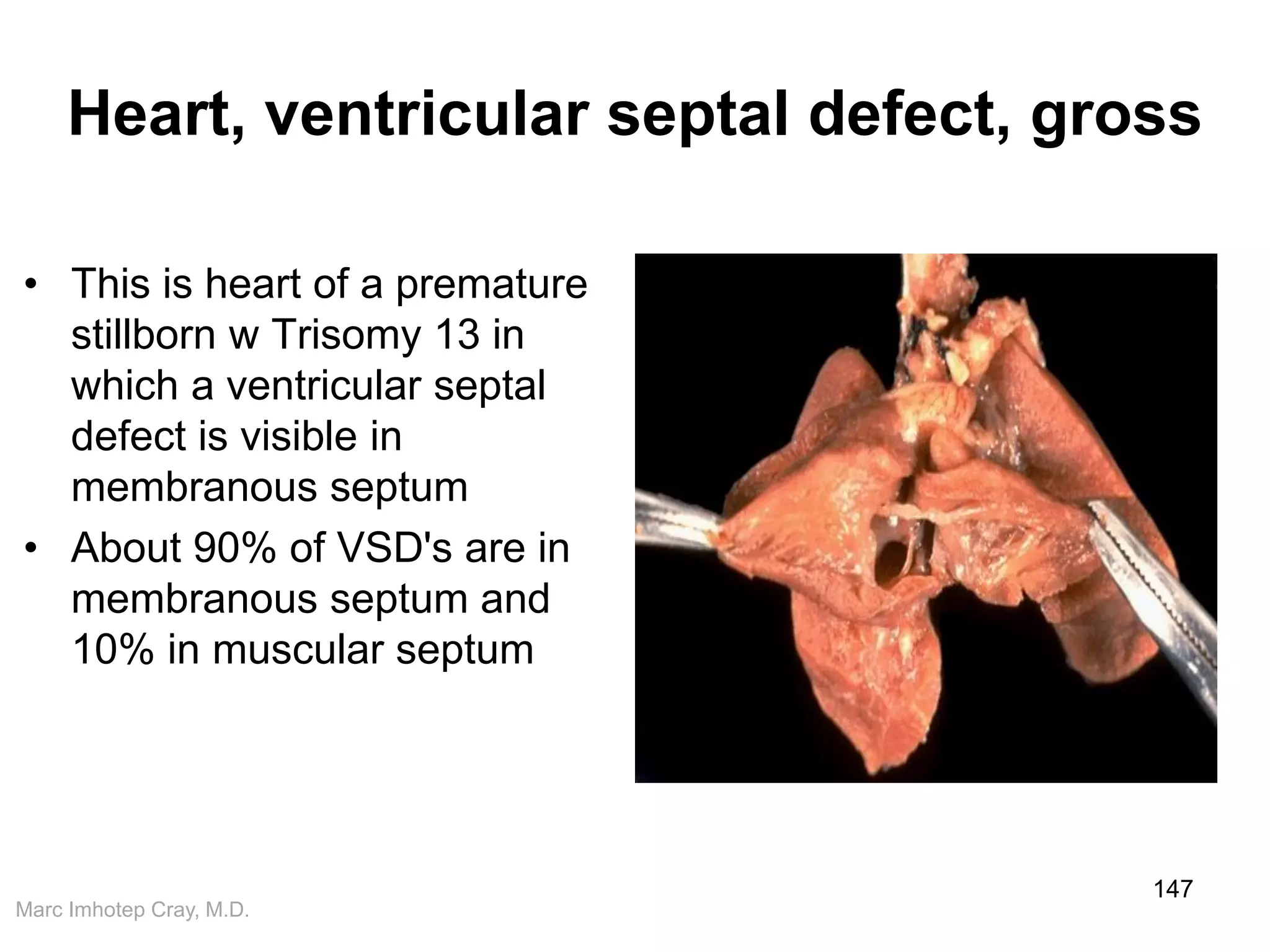 Marc Imhotep Cray, M.D.
Heart, ventricular septal defect, gross
• This is heart of a premature
stillborn w Trisomy 13 in
which a ventricular septal
defect is visible in
membranous septum
• About 90% of VSD's are in
membranous septum and
10% in muscular septum
147
 