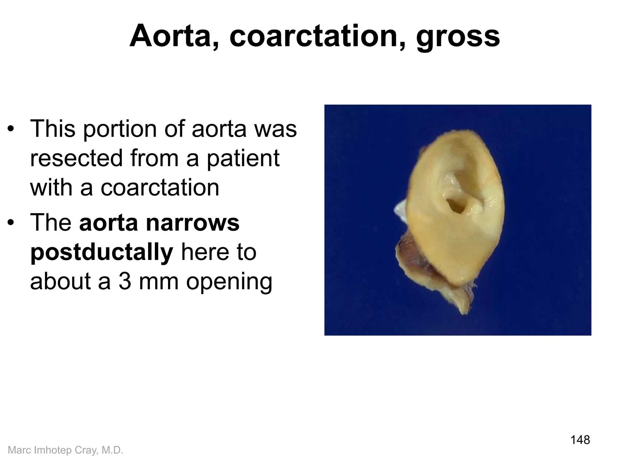 Marc Imhotep Cray, M.D.
Aorta, coarctation, gross
• This portion of aorta was
resected from a patient
with a coarctation
• The aorta narrows
postductally here to
about a 3 mm opening
148
 