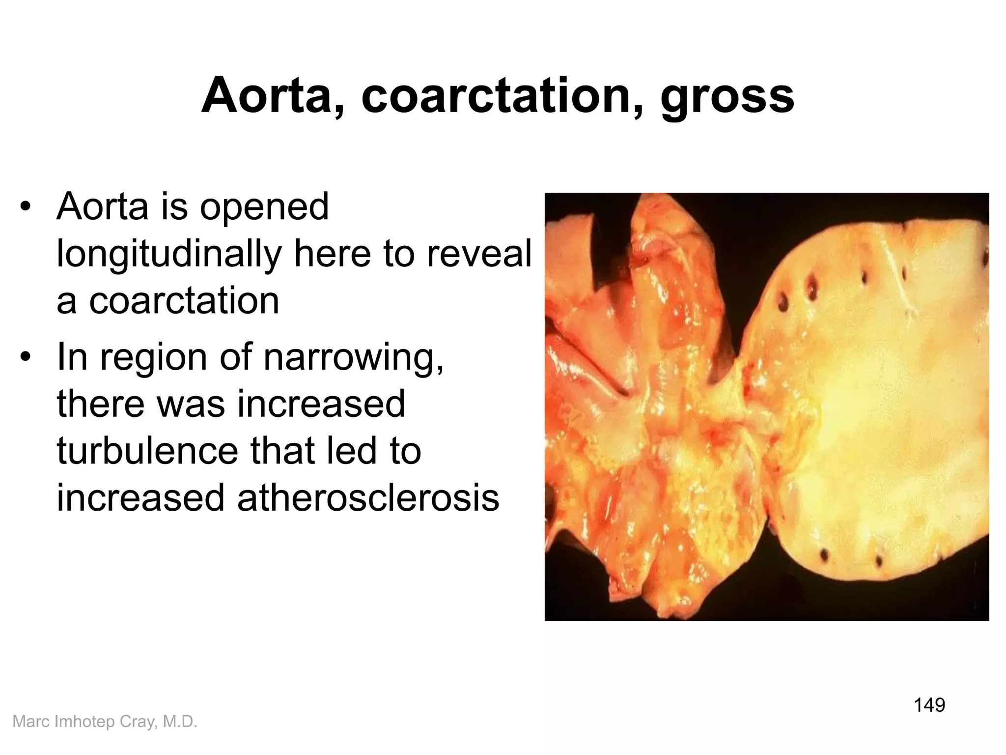 Marc Imhotep Cray, M.D.
Aorta, coarctation, gross
• Aorta is opened
longitudinally here to reveal
a coarctation
• In region of narrowing,
there was increased
turbulence that led to
increased atherosclerosis
149
 