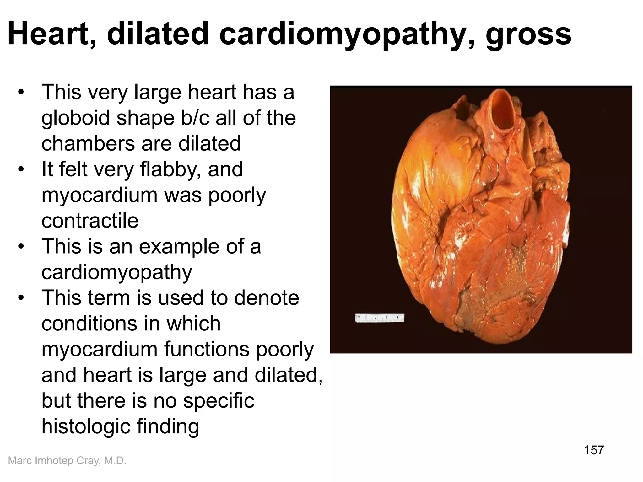 Marc Imhotep Cray, M.D.
Heart, dilated cardiomyopathy, gross
157
• This very large heart has a
globoid shape b/c all of the
chambers are dilated
• It felt very flabby, and
myocardium was poorly
contractile
• This is an example of a
cardiomyopathy
• This term is used to denote
conditions in which
myocardium functions poorly
and heart is large and dilated,
but there is no specific
histologic finding
 