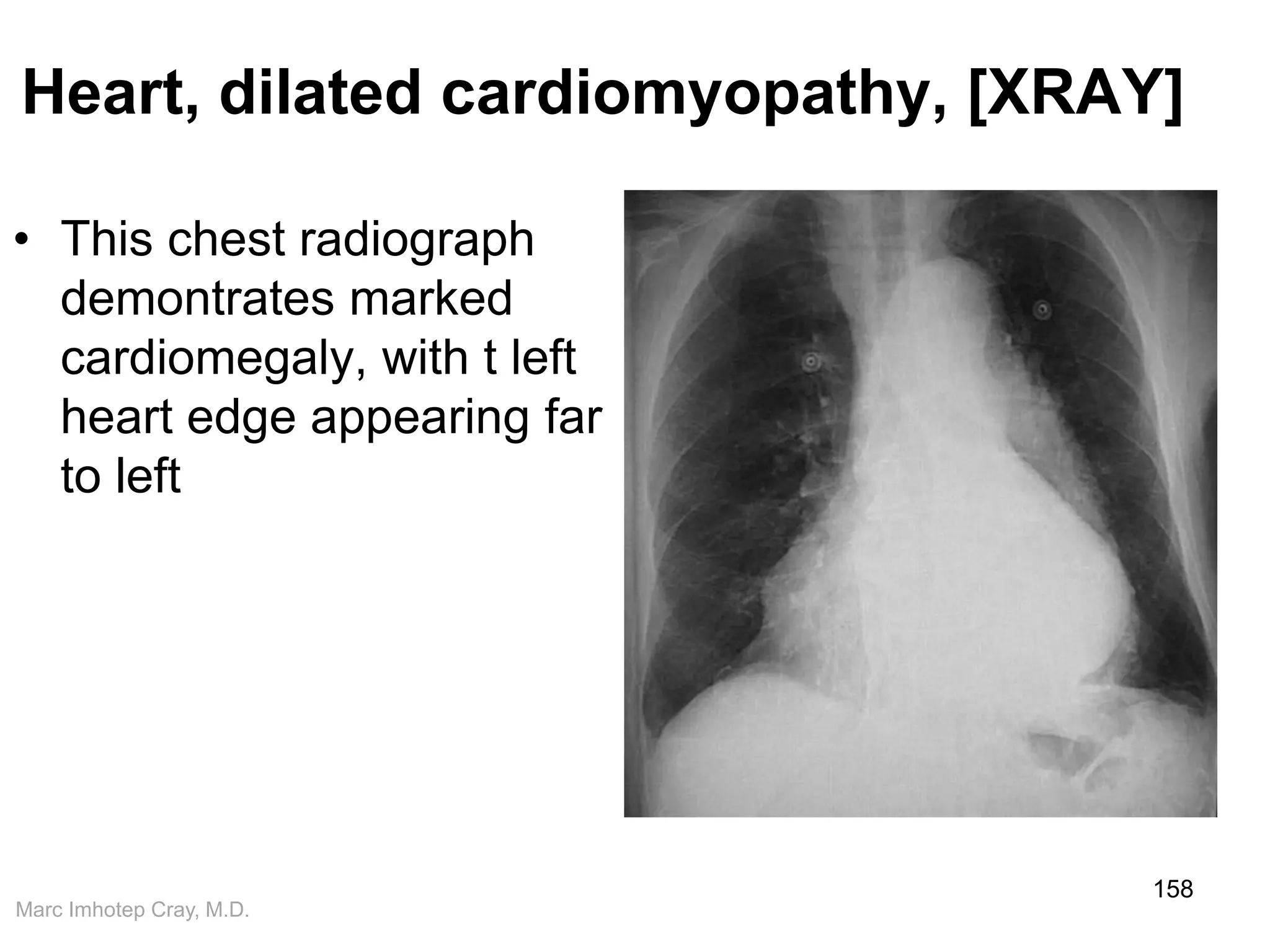 Marc Imhotep Cray, M.D.
Heart, dilated cardiomyopathy, [XRAY]
• This chest radiograph
demontrates marked
cardiomegaly, with t left
heart edge appearing far
to left
158
 