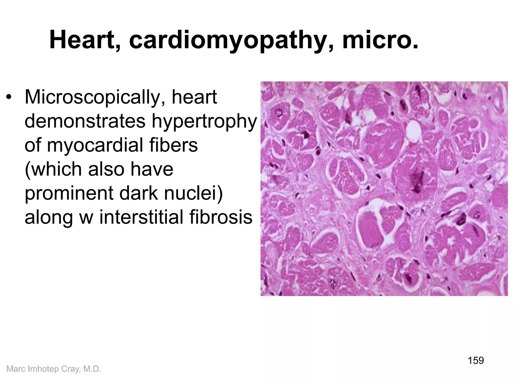 Marc Imhotep Cray, M.D.
Heart, cardiomyopathy, micro.
• Microscopically, heart
demonstrates hypertrophy
of myocardial fibers
(which also have
prominent dark nuclei)
along w interstitial fibrosis
159
 