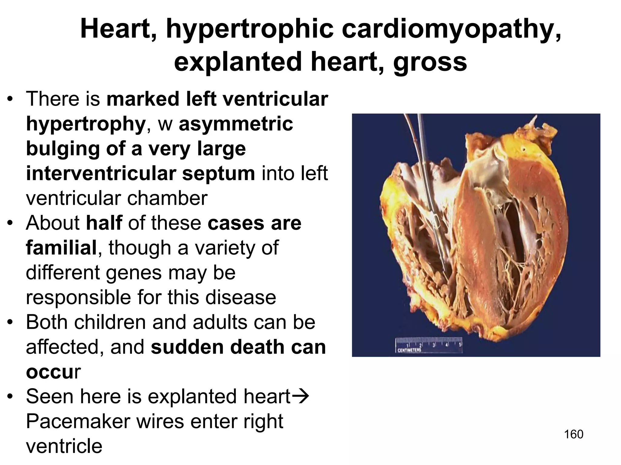 Marc Imhotep Cray, M.D.
Heart, hypertrophic cardiomyopathy,
explanted heart, gross
160
• There is marked left ventricular
hypertrophy, w asymmetric
bulging of a very large
interventricular septum into left
ventricular chamber
• About half of these cases are
familial, though a variety of
different genes may be
responsible for this disease
• Both children and adults can be
affected, and sudden death can
occur
• Seen here is explanted heart
Pacemaker wires enter right
ventricle
 