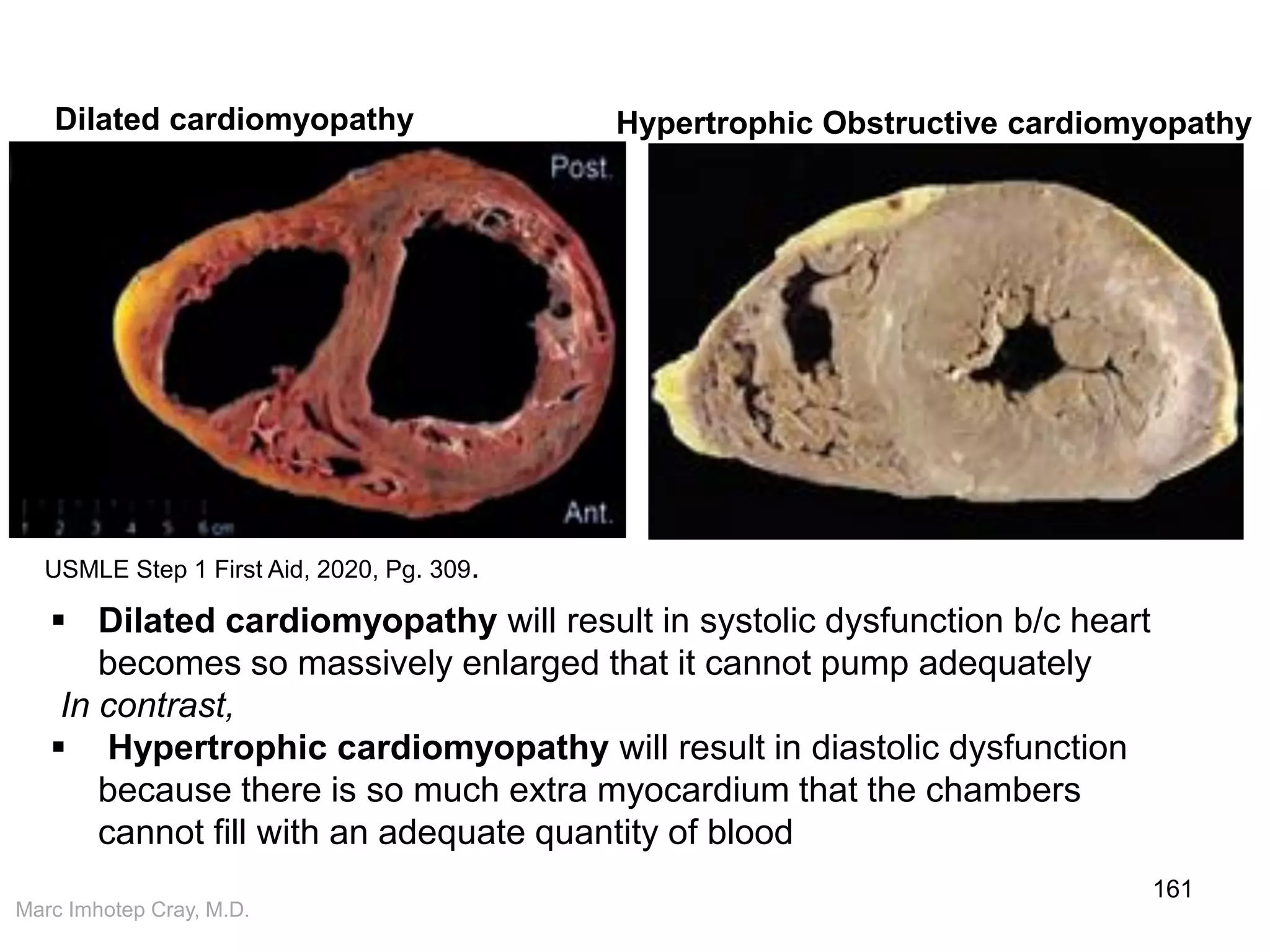 Marc Imhotep Cray, M.D.
161
Dilated cardiomyopathy Hypertrophic Obstructive cardiomyopathy
USMLE Step 1 First Aid, 2020, Pg. 309.
 Dilated cardiomyopathy will result in systolic dysfunction b/c heart
becomes so massively enlarged that it cannot pump adequately
In contrast,
 Hypertrophic cardiomyopathy will result in diastolic dysfunction
because there is so much extra myocardium that the chambers
cannot fill with an adequate quantity of blood
 