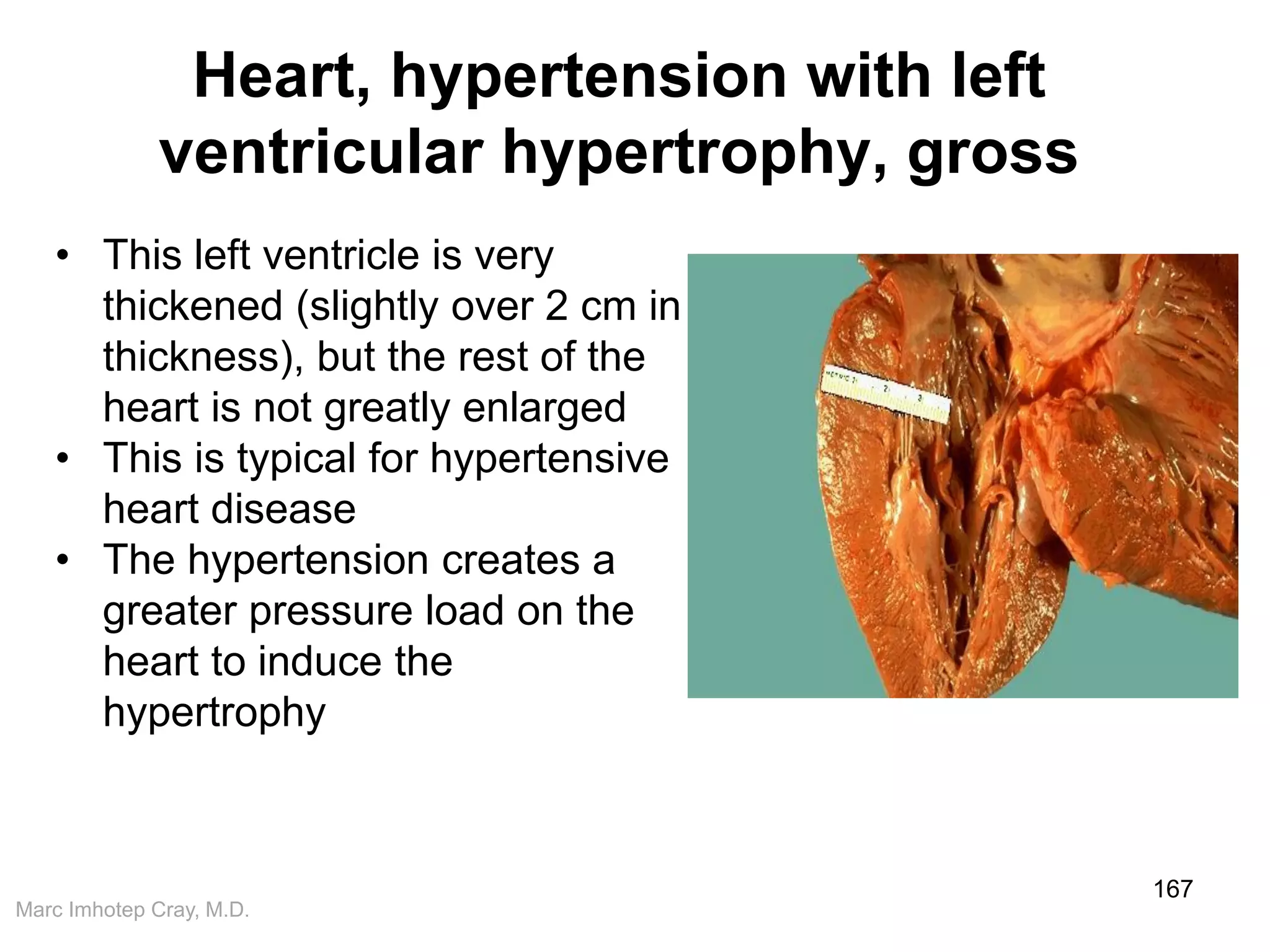 Marc Imhotep Cray, M.D.
Heart, hypertension with left
ventricular hypertrophy, gross
167
• This left ventricle is very
thickened (slightly over 2 cm in
thickness), but the rest of the
heart is not greatly enlarged
• This is typical for hypertensive
heart disease
• The hypertension creates a
greater pressure load on the
heart to induce the
hypertrophy
 