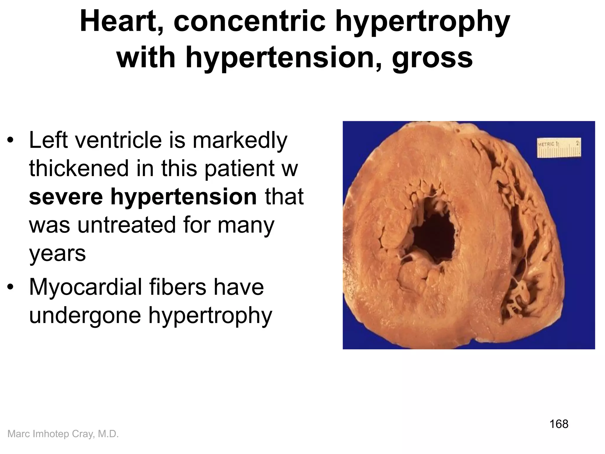 Marc Imhotep Cray, M.D.
Heart, concentric hypertrophy
with hypertension, gross
• Left ventricle is markedly
thickened in this patient w
severe hypertension that
was untreated for many
years
• Myocardial fibers have
undergone hypertrophy
168
 