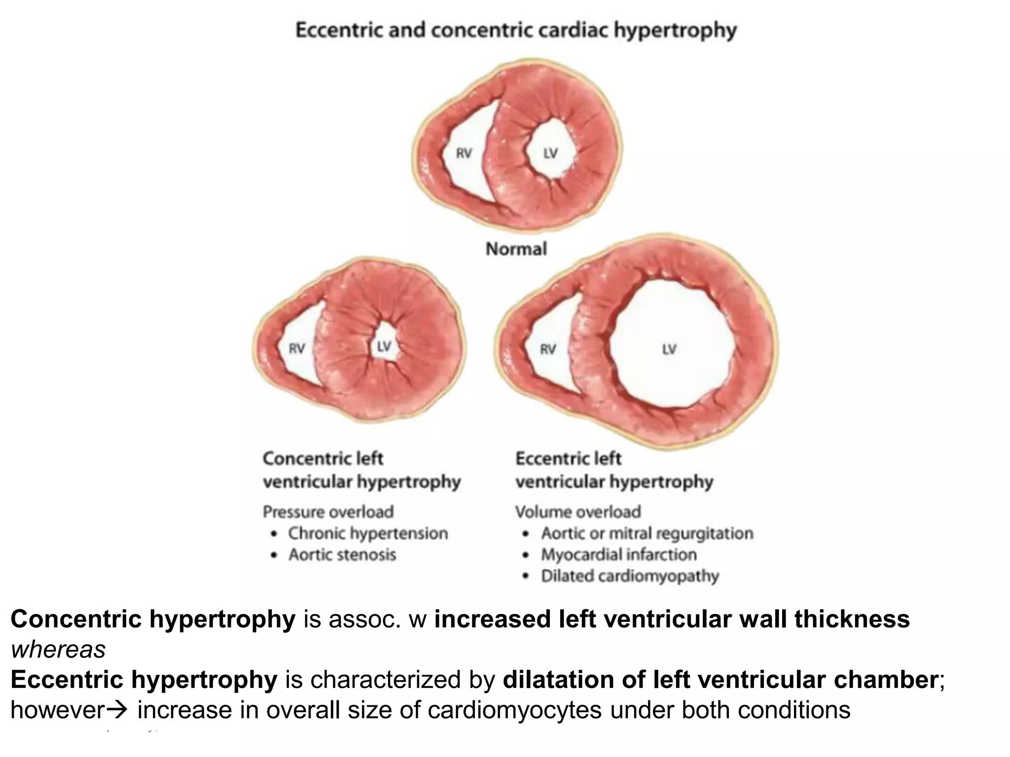 Marc Imhotep Cray, M.D.
169
Concentric hypertrophy is assoc. w increased left ventricular wall thickness
whereas
Eccentric hypertrophy is characterized by dilatation of left ventricular chamber;
however increase in overall size of cardiomyocytes under both conditions
 