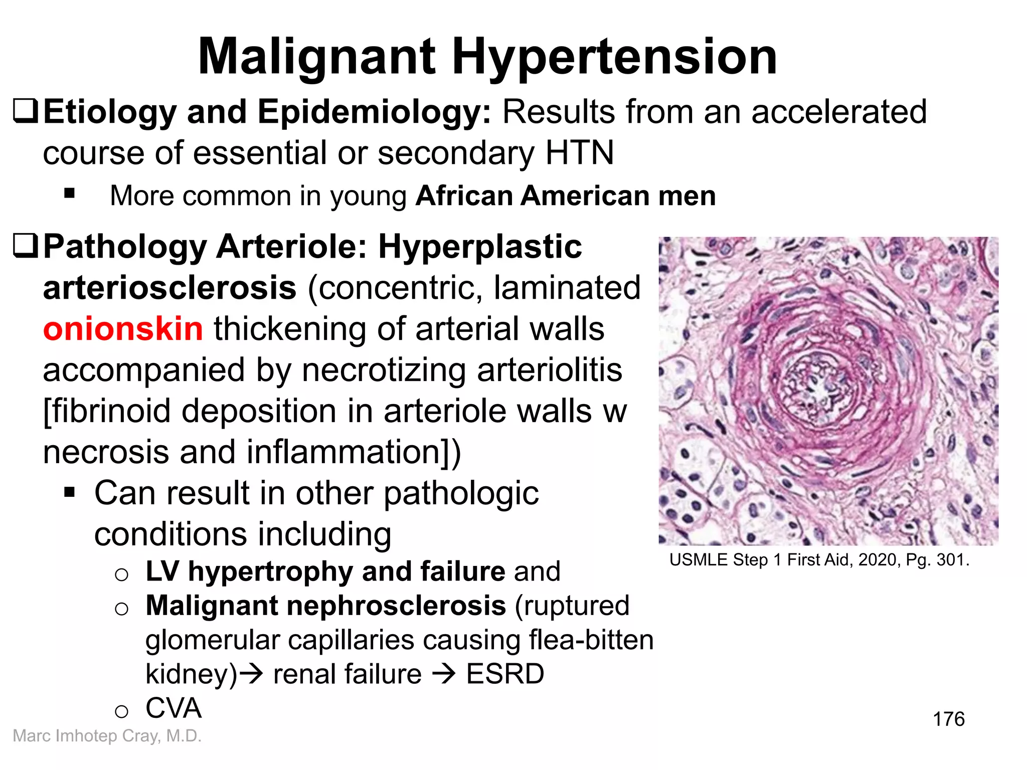 Marc Imhotep Cray, M.D.
Malignant Hypertension
176
Pathology Arteriole: Hyperplastic
arteriosclerosis (concentric, laminated
onionskin thickening of arterial walls
accompanied by necrotizing arteriolitis
[fibrinoid deposition in arteriole walls w
necrosis and inflammation])
 Can result in other pathologic
conditions including
o LV hypertrophy and failure and
o Malignant nephrosclerosis (ruptured
glomerular capillaries causing flea-bitten
kidney) renal failure  ESRD
o CVA
USMLE Step 1 First Aid, 2020, Pg. 301.
Etiology and Epidemiology: Results from an accelerated
course of essential or secondary HTN
 More common in young African American men
 