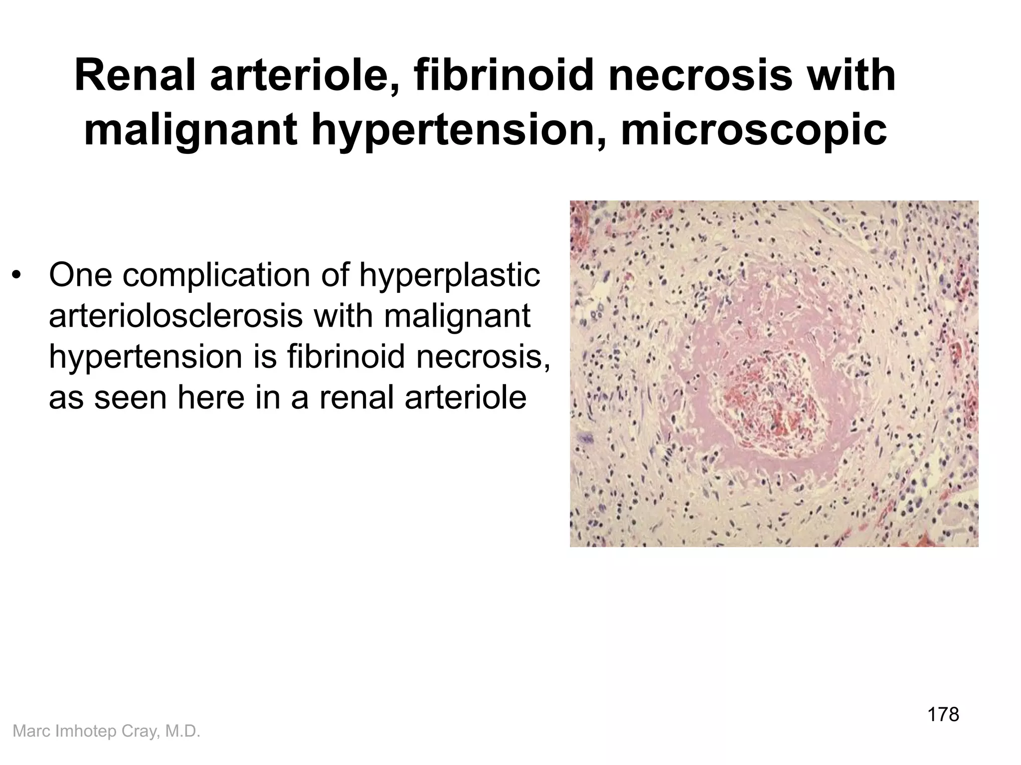 Marc Imhotep Cray, M.D.
Renal arteriole, fibrinoid necrosis with
malignant hypertension, microscopic
• One complication of hyperplastic
arteriolosclerosis with malignant
hypertension is fibrinoid necrosis,
as seen here in a renal arteriole
178
 