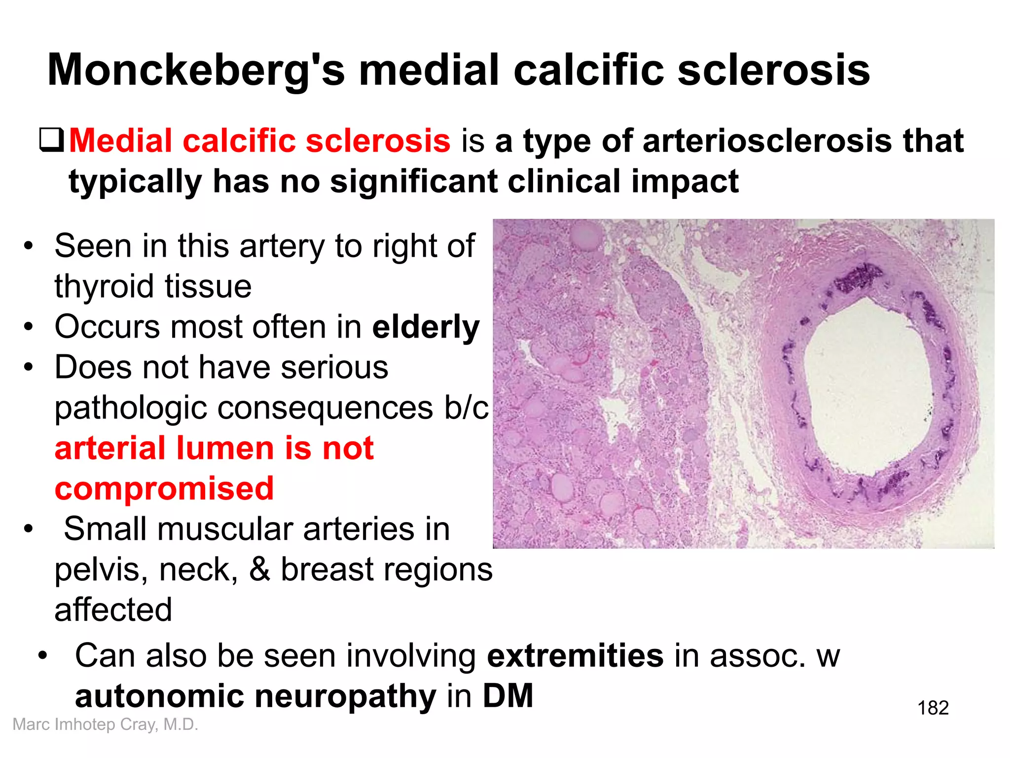 Marc Imhotep Cray, M.D.
182
• Seen in this artery to right of
thyroid tissue
• Occurs most often in elderly
• Does not have serious
pathologic consequences b/c
arterial lumen is not
compromised
• Small muscular arteries in
pelvis, neck, & breast regions
affected
Monckeberg's medial calcific sclerosis
Medial calcific sclerosis is a type of arteriosclerosis that
typically has no significant clinical impact
• Can also be seen involving extremities in assoc. w
autonomic neuropathy in DM
 