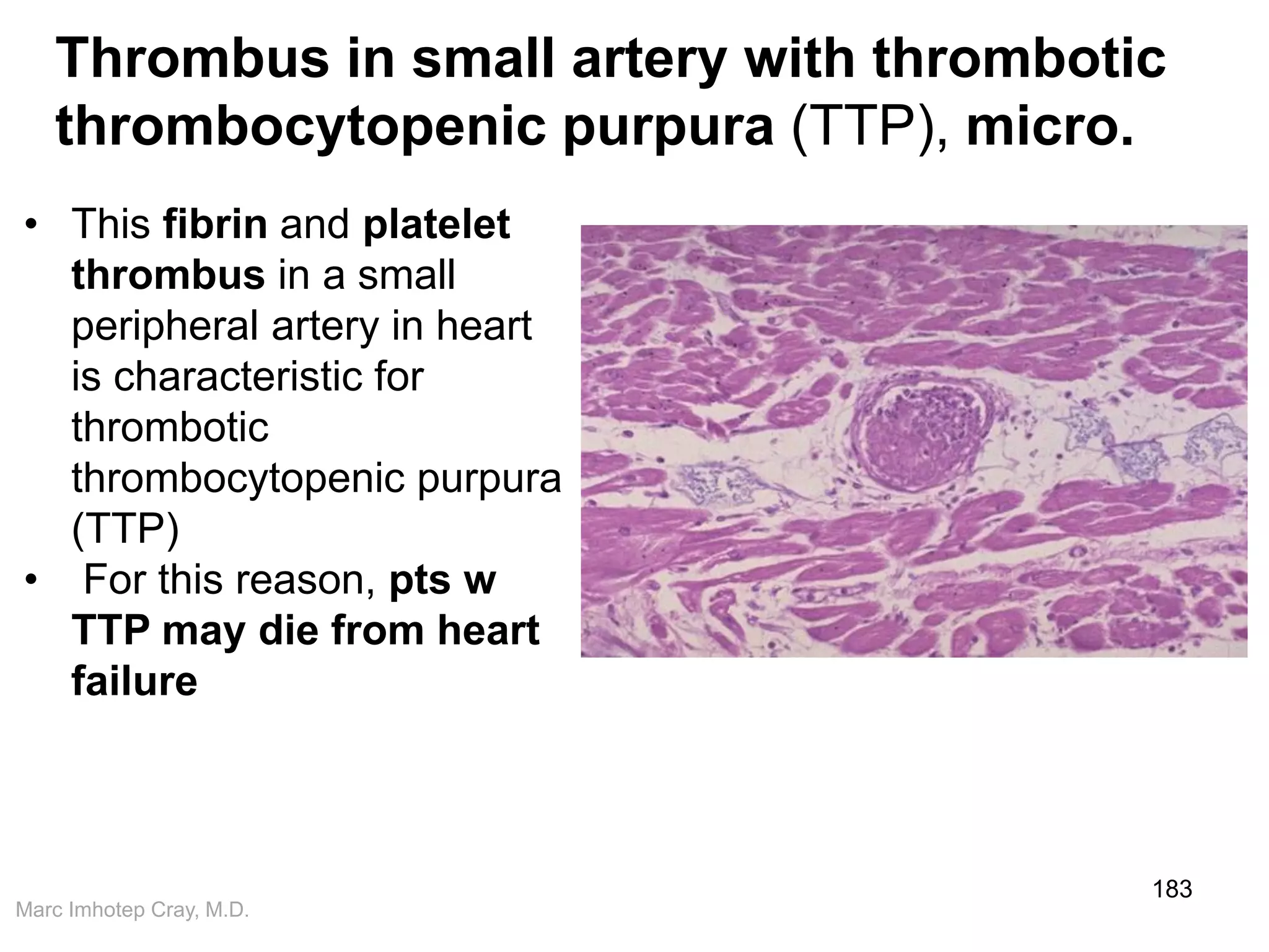 Marc Imhotep Cray, M.D.
183
• This fibrin and platelet
thrombus in a small
peripheral artery in heart
is characteristic for
thrombotic
thrombocytopenic purpura
(TTP)
• For this reason, pts w
TTP may die from heart
failure
Thrombus in small artery with thrombotic
thrombocytopenic purpura (TTP), micro.
 