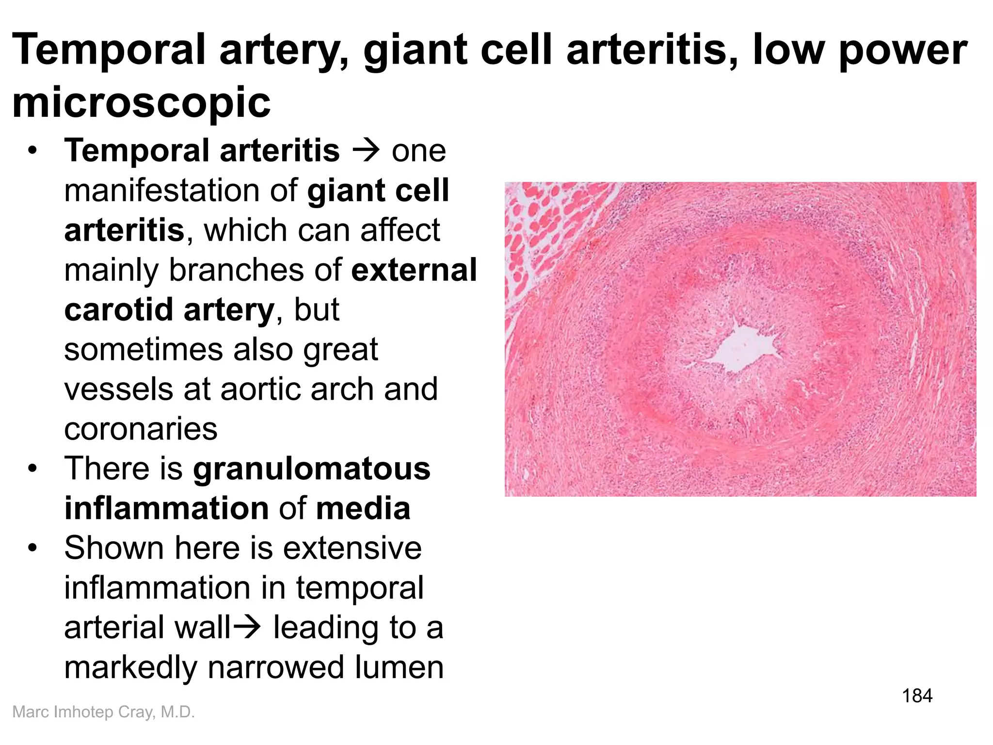 Marc Imhotep Cray, M.D.
184
Temporal artery, giant cell arteritis, low power
microscopic
• Temporal arteritis  one
manifestation of giant cell
arteritis, which can affect
mainly branches of external
carotid artery, but
sometimes also great
vessels at aortic arch and
coronaries
• There is granulomatous
inflammation of media
• Shown here is extensive
inflammation in temporal
arterial wall leading to a
markedly narrowed lumen
 