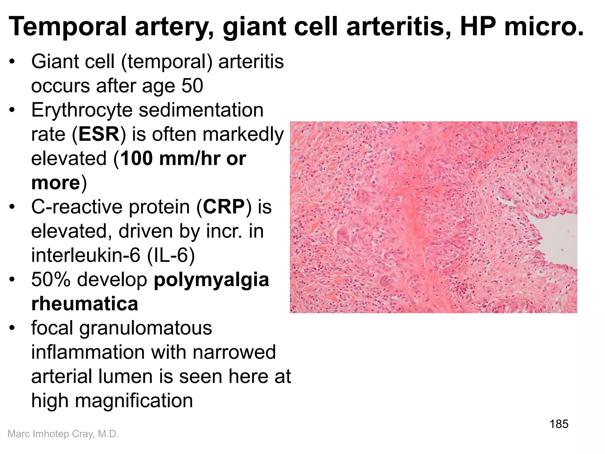 Marc Imhotep Cray, M.D.
185
Temporal artery, giant cell arteritis, HP micro.
• Giant cell (temporal) arteritis
occurs after age 50
• Erythrocyte sedimentation
rate (ESR) is often markedly
elevated (100 mm/hr or
more)
• C-reactive protein (CRP) is
elevated, driven by incr. in
interleukin-6 (IL-6)
• 50% develop polymyalgia
rheumatica
• focal granulomatous
inflammation with narrowed
arterial lumen is seen here at
high magnification
 