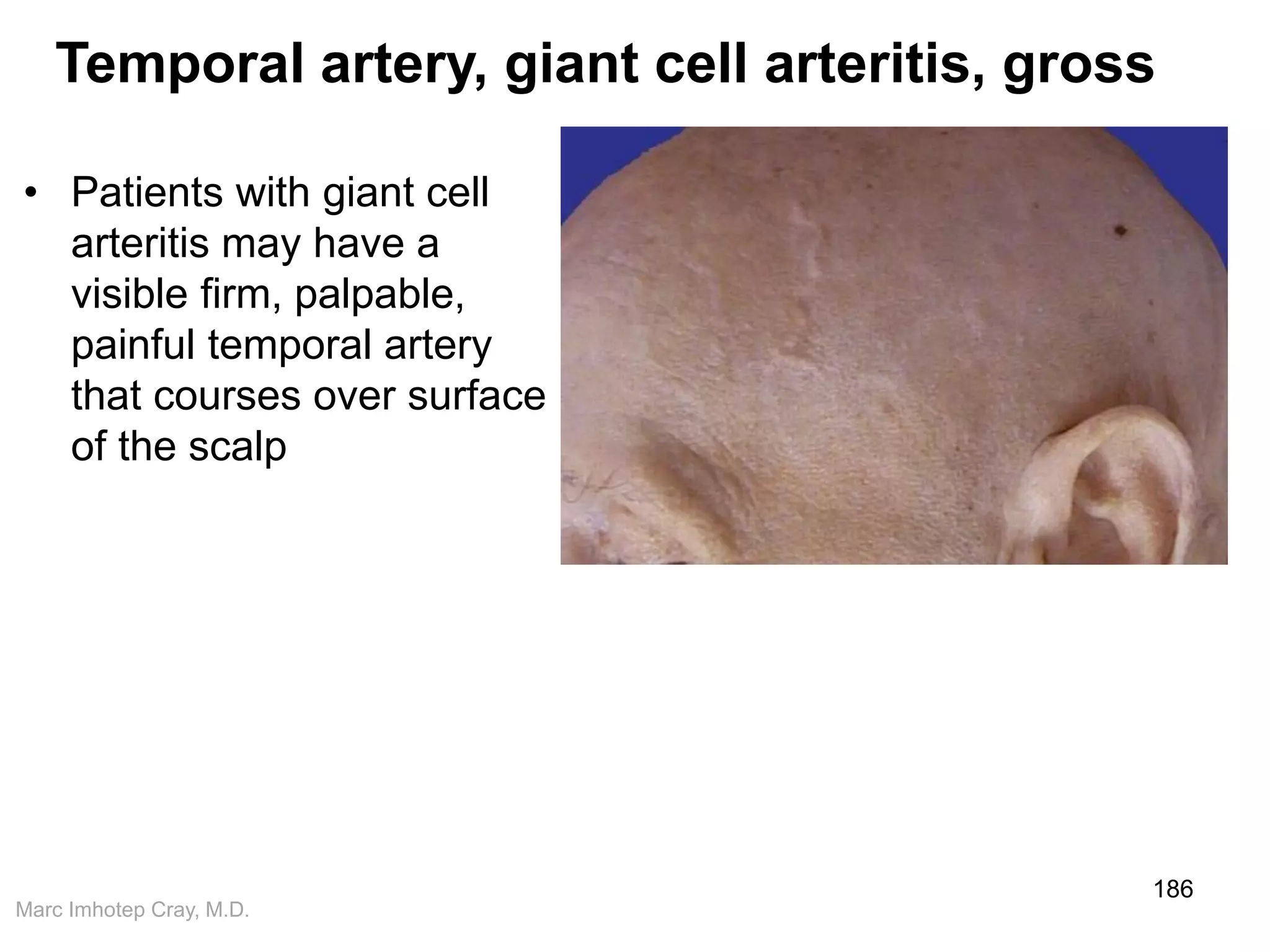Marc Imhotep Cray, M.D.
186
Temporal artery, giant cell arteritis, gross
• Patients with giant cell
arteritis may have a
visible firm, palpable,
painful temporal artery
that courses over surface
of the scalp
 