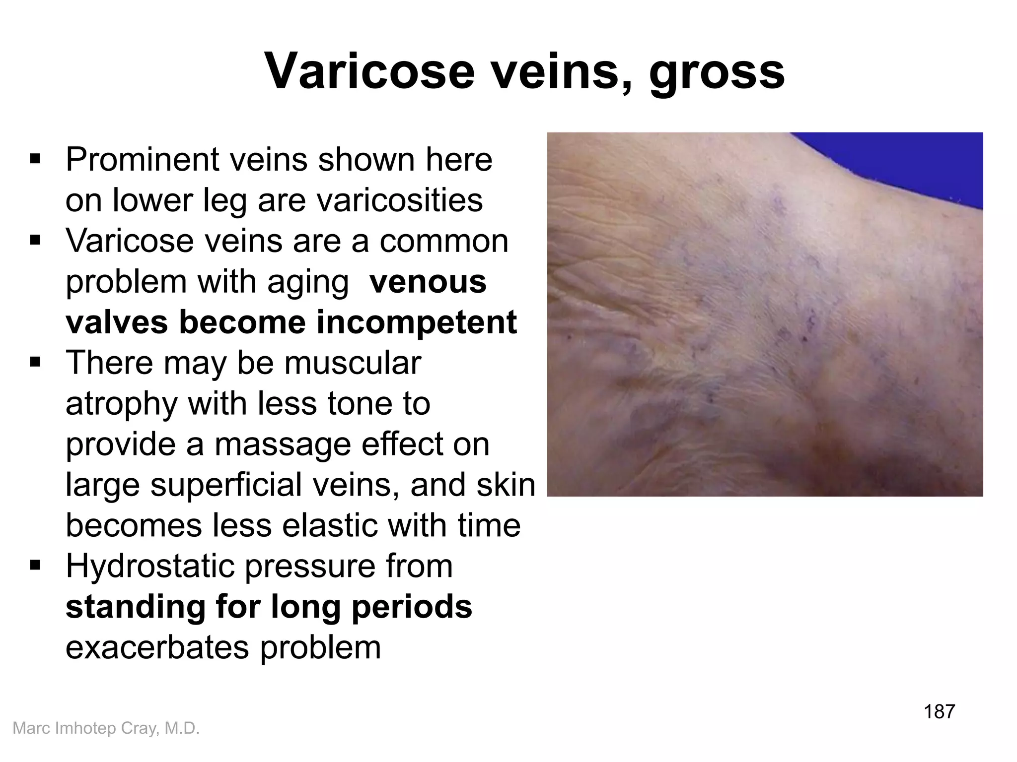 Marc Imhotep Cray, M.D.
Varicose veins, gross
187
 Prominent veins shown here
on lower leg are varicosities
 Varicose veins are a common
problem with aging venous
valves become incompetent
 There may be muscular
atrophy with less tone to
provide a massage effect on
large superficial veins, and skin
becomes less elastic with time
 Hydrostatic pressure from
standing for long periods
exacerbates problem
 