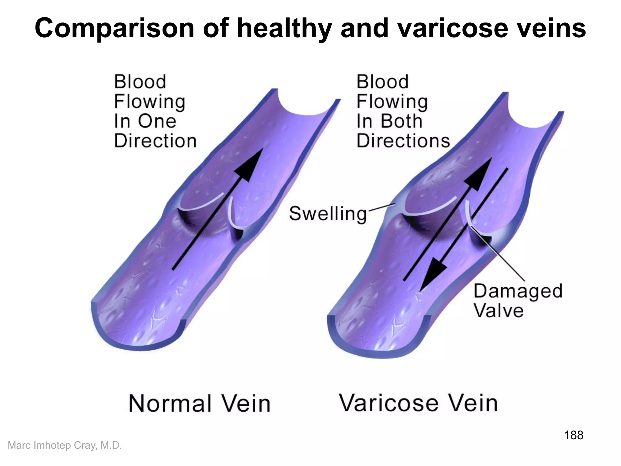 Marc Imhotep Cray, M.D.
Comparison of healthy and varicose veins
188
 