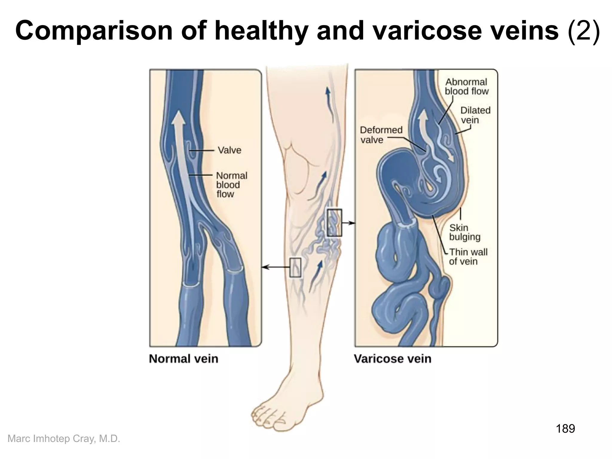 Marc Imhotep Cray, M.D.
189
Comparison of healthy and varicose veins (2)
 