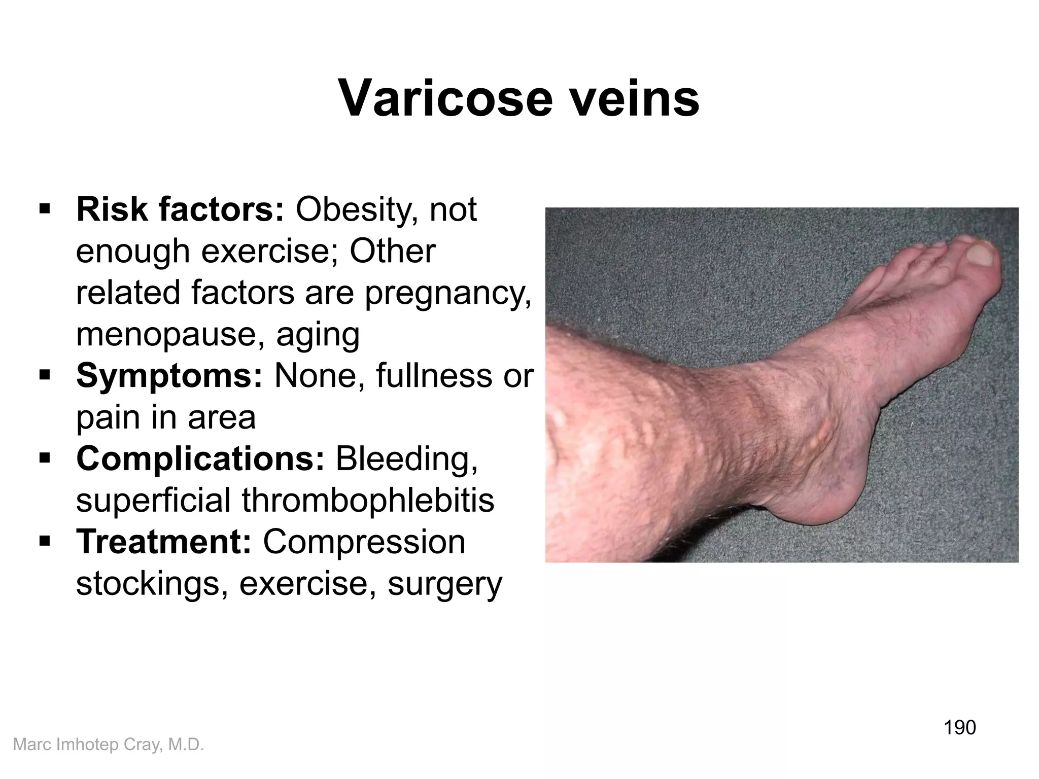 Marc Imhotep Cray, M.D.
Varicose veins
190
 Risk factors: Obesity, not
enough exercise; Other
related factors are pregnancy,
menopause, aging
 Symptoms: None, fullness or
pain in area
 Complications: Bleeding,
superficial thrombophlebitis
 Treatment: Compression
stockings, exercise, surgery
 