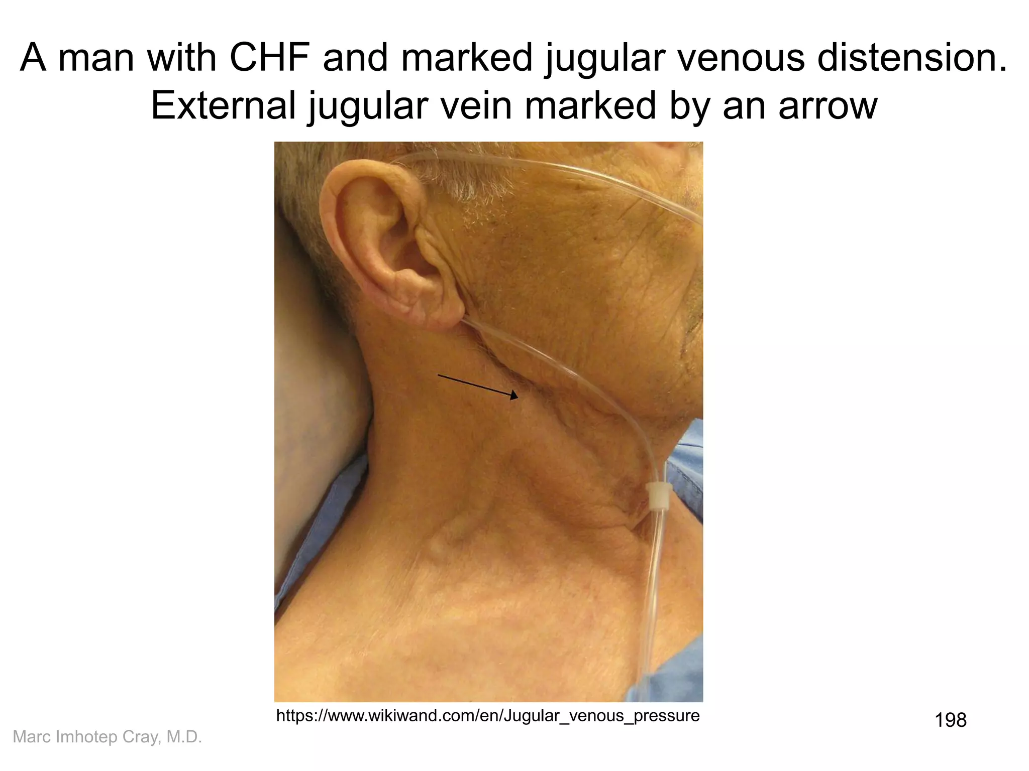 Marc Imhotep Cray, M.D.
A man with CHF and marked jugular venous distension.
External jugular vein marked by an arrow
198https://www.wikiwand.com/en/Jugular_venous_pressure
 