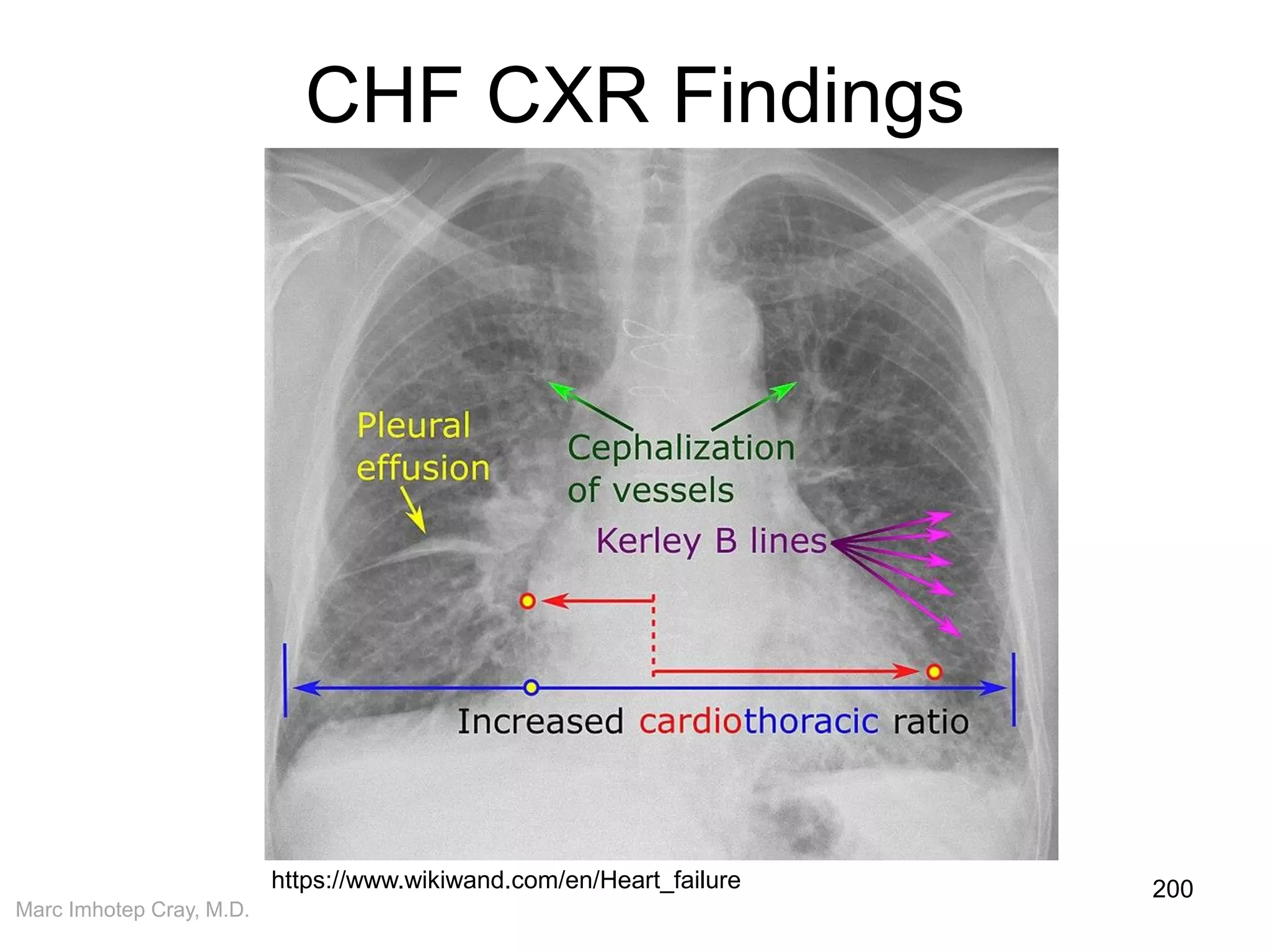 Marc Imhotep Cray, M.D.
CHF CXR Findings
200https://www.wikiwand.com/en/Heart_failure
 