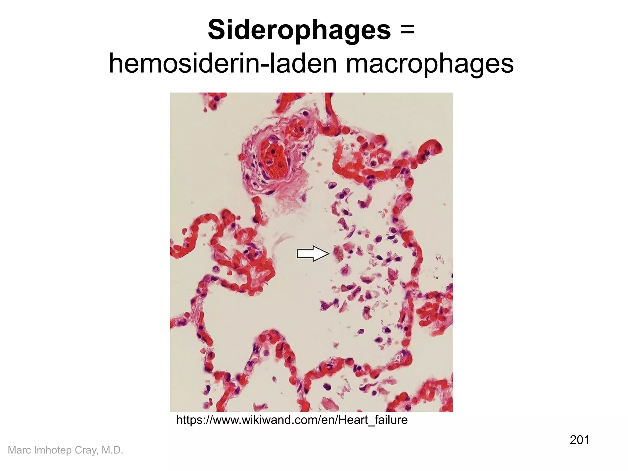 Marc Imhotep Cray, M.D.
Siderophages =
hemosiderin-laden macrophages
201
https://www.wikiwand.com/en/Heart_failure
 