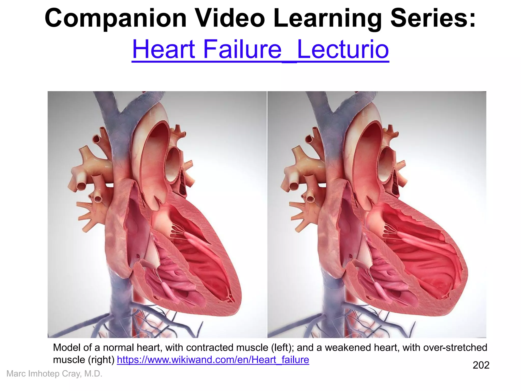 Marc Imhotep Cray, M.D.
Companion Video Learning Series:
Heart Failure_Lecturio
202
Model of a normal heart, with contracted muscle (left); and a weakened heart, with over-stretched
muscle (right) https://www.wikiwand.com/en/Heart_failure
 