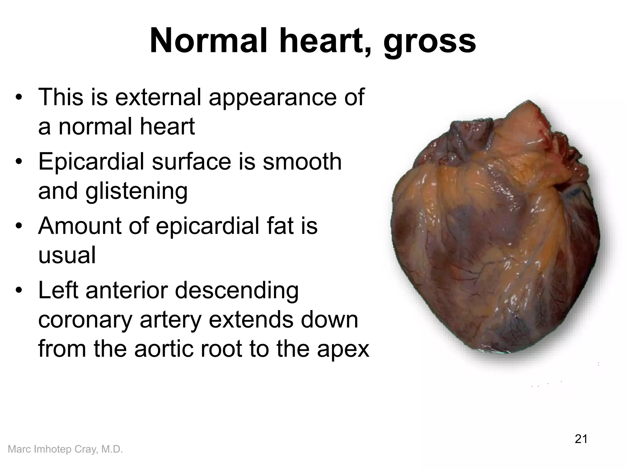 Marc Imhotep Cray, M.D.
Normal heart, gross
• This is external appearance of
a normal heart
• Epicardial surface is smooth
and glistening
• Amount of epicardial fat is
usual
• Left anterior descending
coronary artery extends down
from the aortic root to the apex
21
 