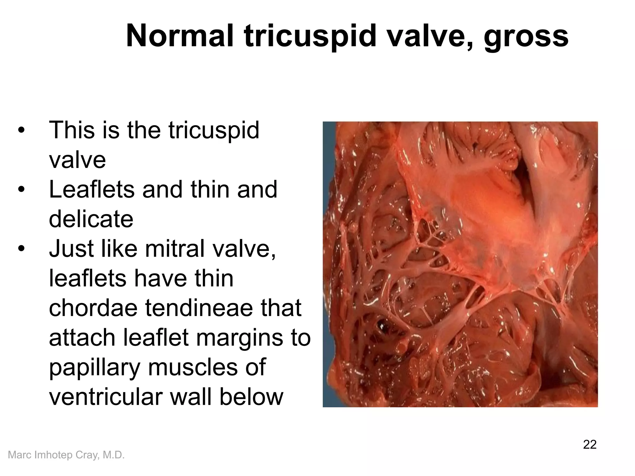 Marc Imhotep Cray, M.D.
Normal tricuspid valve, gross
22
• This is the tricuspid
valve
• Leaflets and thin and
delicate
• Just like mitral valve,
leaflets have thin
chordae tendineae that
attach leaflet margins to
papillary muscles of
ventricular wall below
 