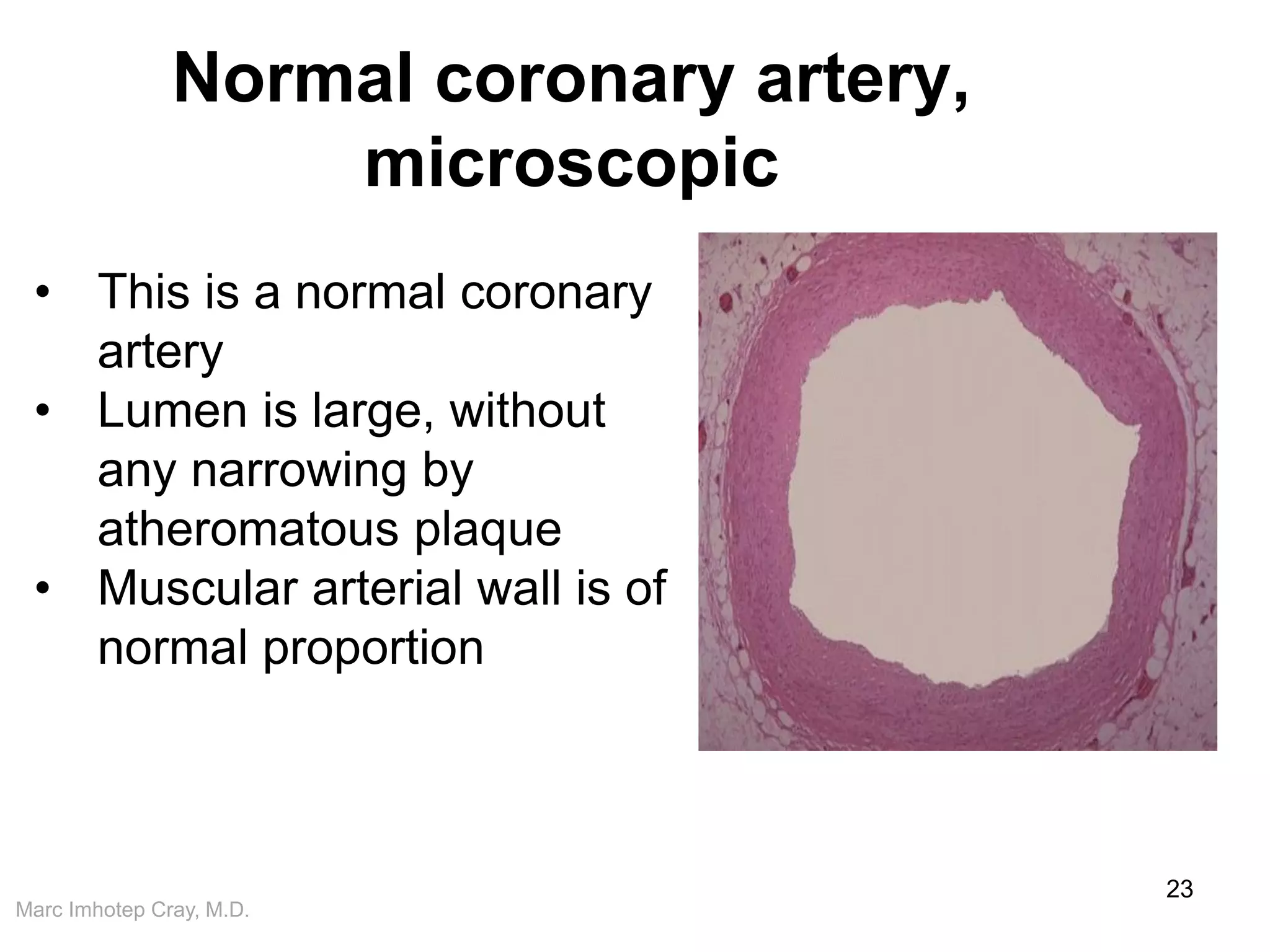 Marc Imhotep Cray, M.D.
Normal coronary artery,
microscopic
23
• This is a normal coronary
artery
• Lumen is large, without
any narrowing by
atheromatous plaque
• Muscular arterial wall is of
normal proportion
 
