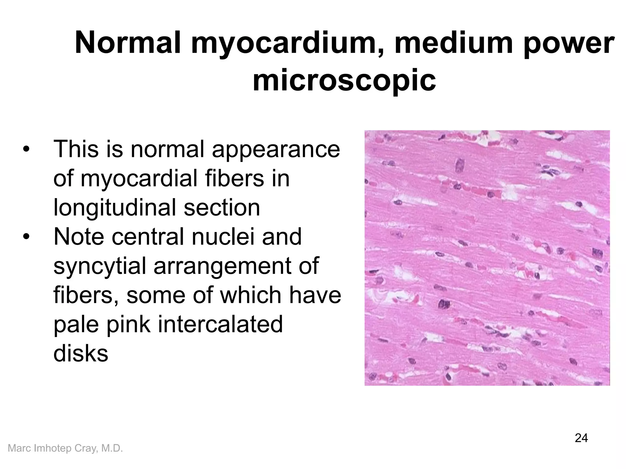 Marc Imhotep Cray, M.D.
Normal myocardium, medium power
microscopic
24
• This is normal appearance
of myocardial fibers in
longitudinal section
• Note central nuclei and
syncytial arrangement of
fibers, some of which have
pale pink intercalated
disks
 