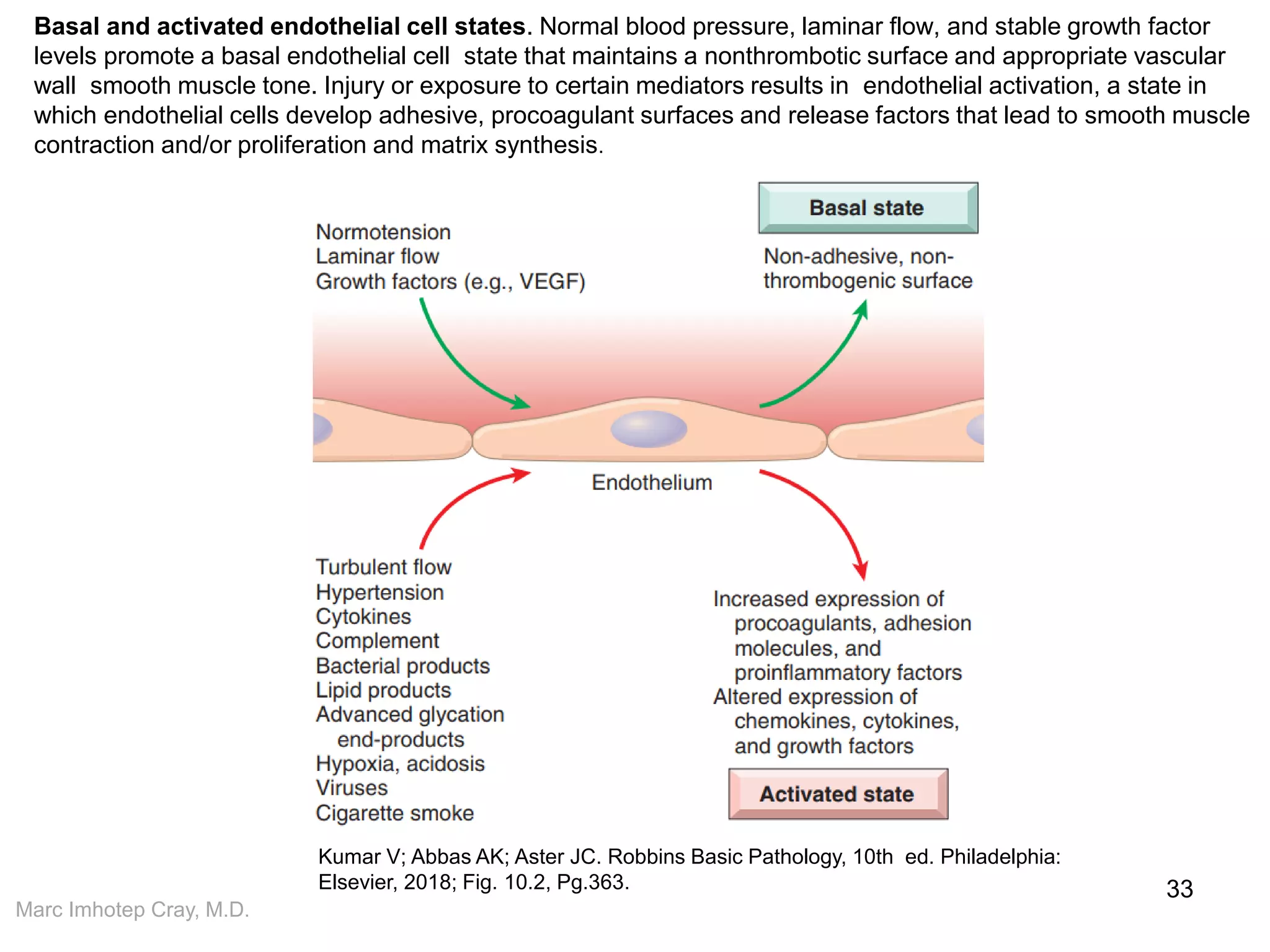 Marc Imhotep Cray, M.D.
Basal and activated endothelial cell states. Normal blood pressure, laminar flow, and stable growth factor
levels promote a basal endothelial cell state that maintains a nonthrombotic surface and appropriate vascular
wall smooth muscle tone. Injury or exposure to certain mediators results in endothelial activation, a state in
which endothelial cells develop adhesive, procoagulant surfaces and release factors that lead to smooth muscle
contraction and/or proliferation and matrix synthesis.
33
Kumar V; Abbas AK; Aster JC. Robbins Basic Pathology, 10th ed. Philadelphia:
Elsevier, 2018; Fig. 10.2, Pg.363.
 
