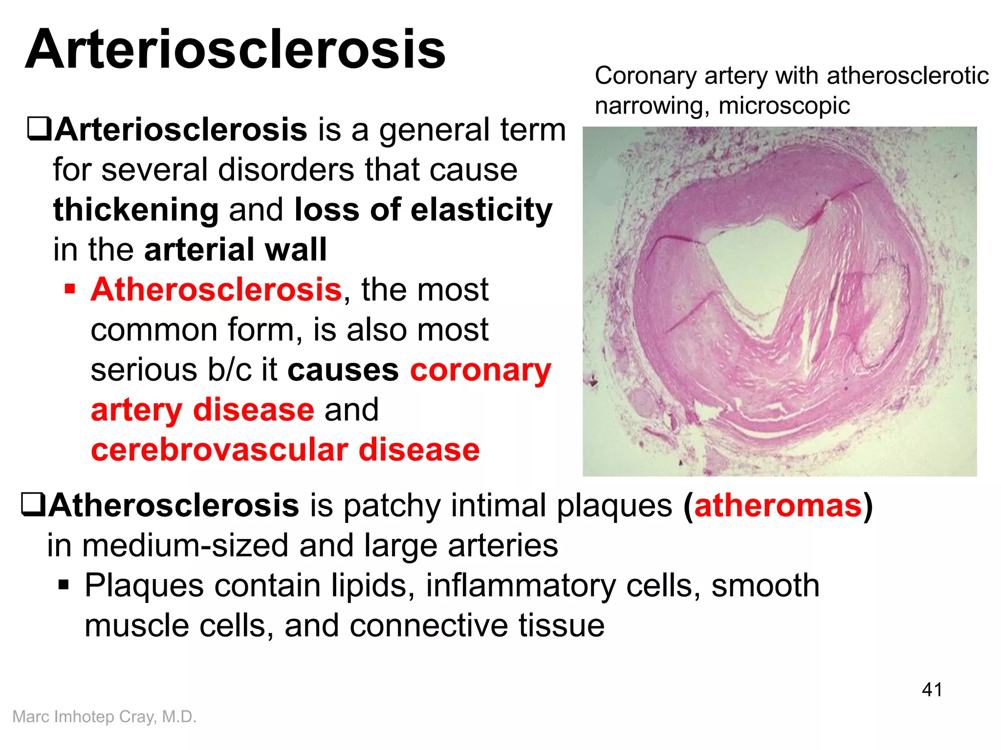 Marc Imhotep Cray, M.D.
Arteriosclerosis
41
Arteriosclerosis is a general term
for several disorders that cause
thickening and loss of elasticity
in the arterial wall
 Atherosclerosis, the most
common form, is also most
serious b/c it causes coronary
artery disease and
cerebrovascular disease
Atherosclerosis is patchy intimal plaques (atheromas)
in medium-sized and large arteries
 Plaques contain lipids, inflammatory cells, smooth
muscle cells, and connective tissue
Coronary artery with atherosclerotic
narrowing, microscopic
 