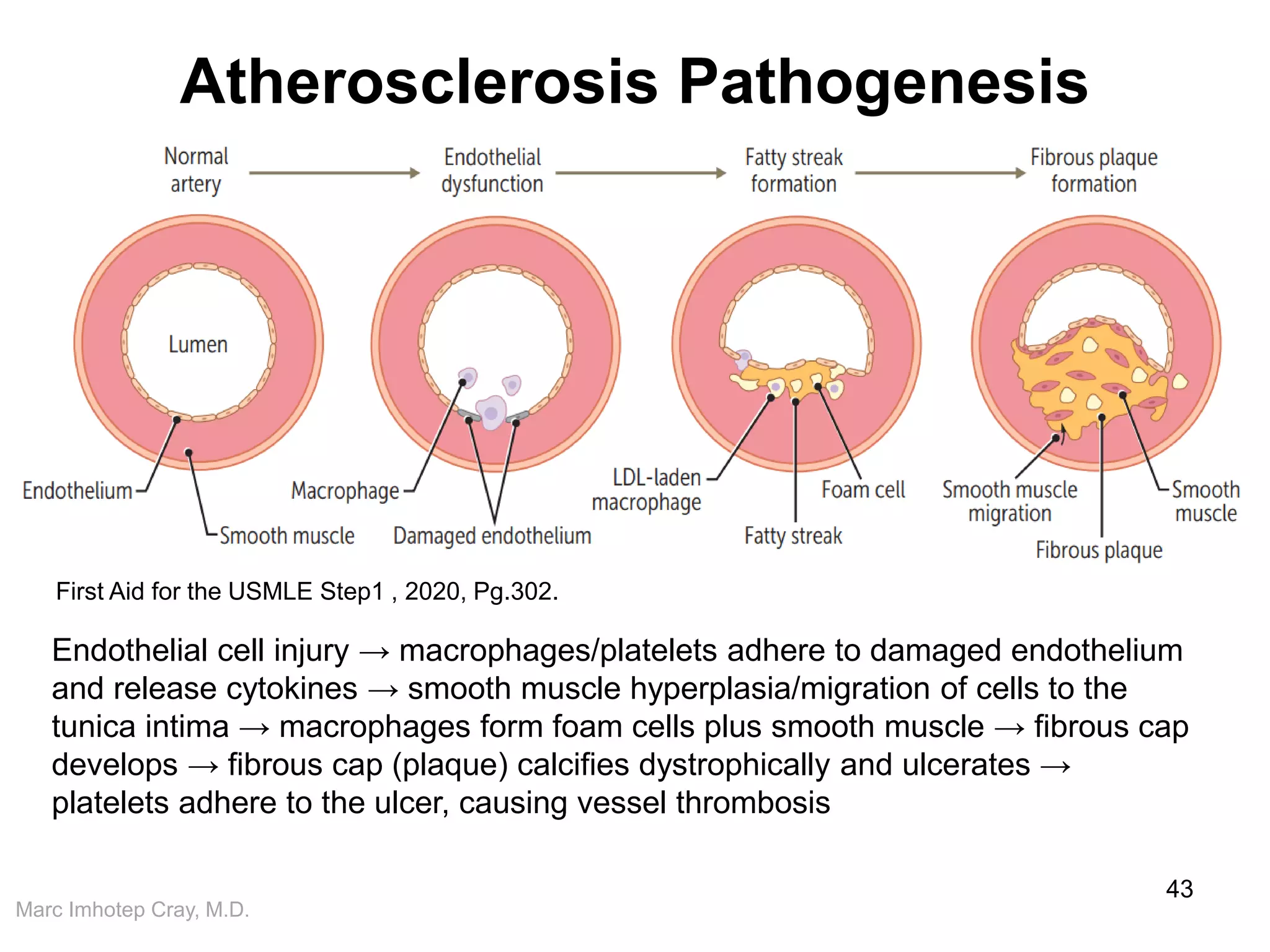 Marc Imhotep Cray, M.D.
Atherosclerosis Pathogenesis
43
First Aid for the USMLE Step1 , 2020, Pg.302.
Endothelial cell injury → macrophages/platelets adhere to damaged endothelium
and release cytokines → smooth muscle hyperplasia/migration of cells to the
tunica intima → macrophages form foam cells plus smooth muscle → fibrous cap
develops → fibrous cap (plaque) calcifies dystrophically and ulcerates →
platelets adhere to the ulcer, causing vessel thrombosis
 