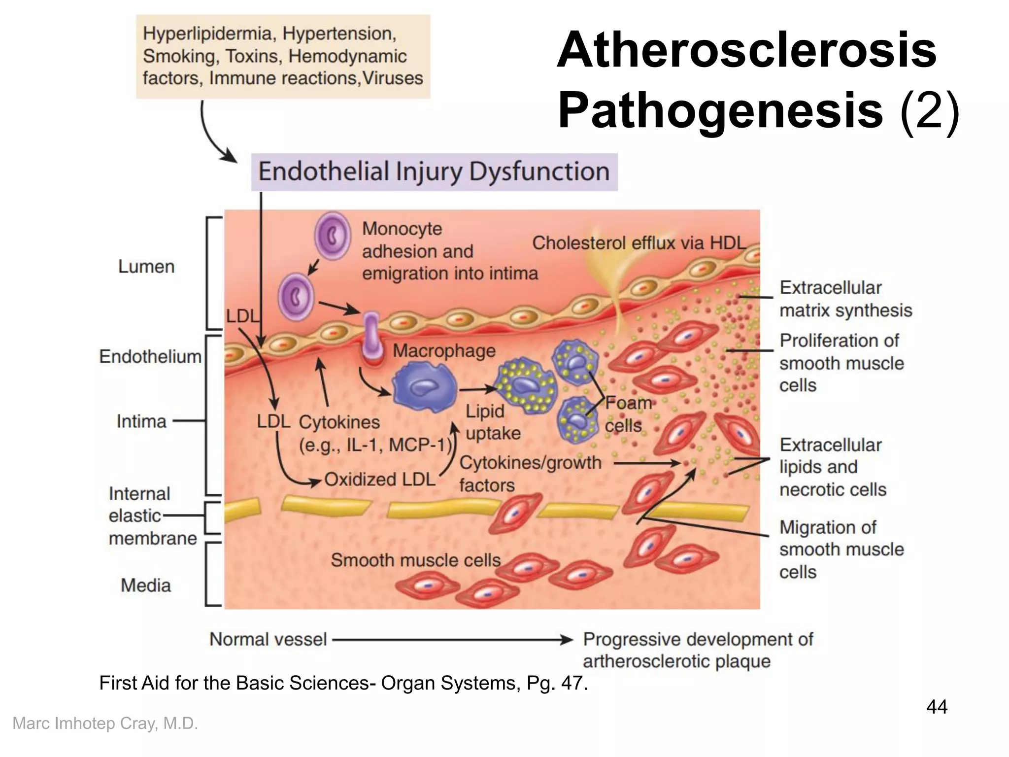 Marc Imhotep Cray, M.D.
44
Atherosclerosis
Pathogenesis (2)
First Aid for the Basic Sciences- Organ Systems, Pg. 47.
 