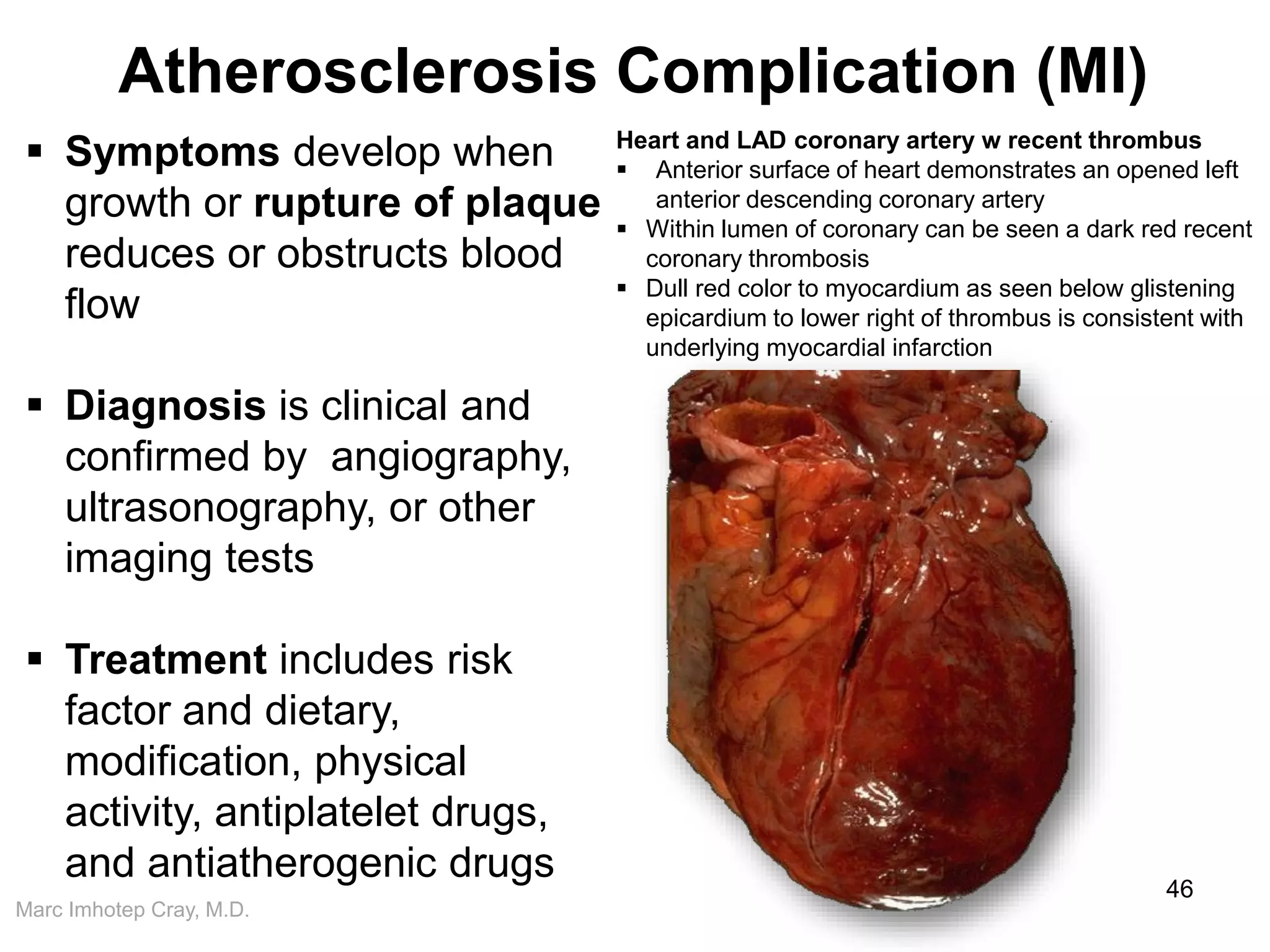 Marc Imhotep Cray, M.D.
Atherosclerosis Complication (MI)
46
 Symptoms develop when
growth or rupture of plaque
reduces or obstructs blood
flow
 Diagnosis is clinical and
confirmed by angiography,
ultrasonography, or other
imaging tests
 Treatment includes risk
factor and dietary,
modification, physical
activity, antiplatelet drugs,
and antiatherogenic drugs
Heart and LAD coronary artery w recent thrombus
 Anterior surface of heart demonstrates an opened left
anterior descending coronary artery
 Within lumen of coronary can be seen a dark red recent
coronary thrombosis
 Dull red color to myocardium as seen below glistening
epicardium to lower right of thrombus is consistent with
underlying myocardial infarction
 