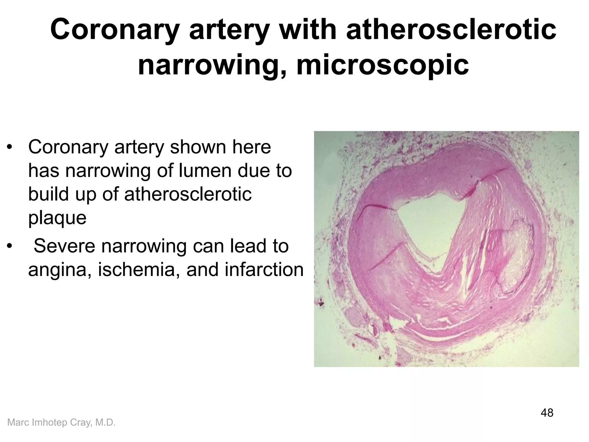 Marc Imhotep Cray, M.D.
Coronary artery with atherosclerotic
narrowing, microscopic
• Coronary artery shown here
has narrowing of lumen due to
build up of atherosclerotic
plaque
• Severe narrowing can lead to
angina, ischemia, and infarction
48
 