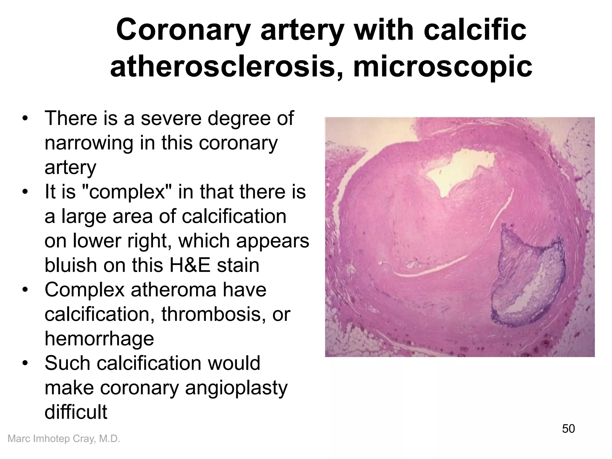 Marc Imhotep Cray, M.D.
Coronary artery with calcific
atherosclerosis, microscopic
50
• There is a severe degree of
narrowing in this coronary
artery
• It is "complex" in that there is
a large area of calcification
on lower right, which appears
bluish on this H&E stain
• Complex atheroma have
calcification, thrombosis, or
hemorrhage
• Such calcification would
make coronary angioplasty
difficult
 