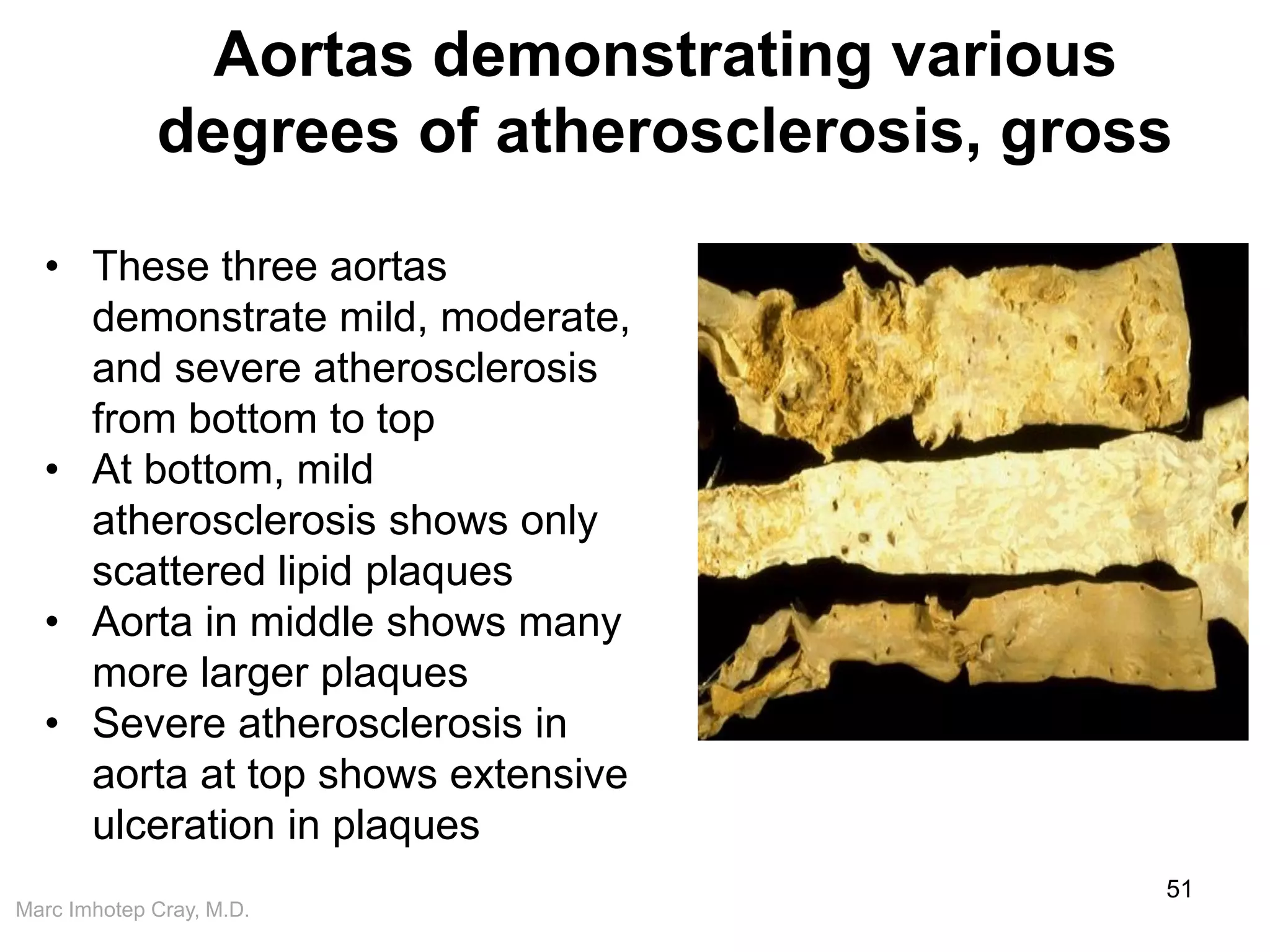 Marc Imhotep Cray, M.D.
Aortas demonstrating various
degrees of atherosclerosis, gross
51
• These three aortas
demonstrate mild, moderate,
and severe atherosclerosis
from bottom to top
• At bottom, mild
atherosclerosis shows only
scattered lipid plaques
• Aorta in middle shows many
more larger plaques
• Severe atherosclerosis in
aorta at top shows extensive
ulceration in plaques
 